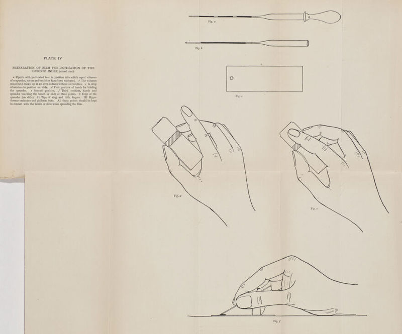 PREPARATION OF FILM FOR ESTIMATION OF THE OPSONIC INDEX (actual size). a Pipette with perforated teat in position into which equal volumes of corpuscles, serum and emulsion have been aspirated, b The volumes mixed and drawn up in an even column without air bubbles, c A drop of mixture in position on slide, d First position of hands for holding the spreader. e Second position, f Third position, hands and spreader touching the bench or slide at three points. I Edge of the spreader (on slide). II Tips of ring and little fingers. Ill Hypo- themar eminence and pisiform bone. All these points should be kept in contact with the bench or slide when spreading the film.