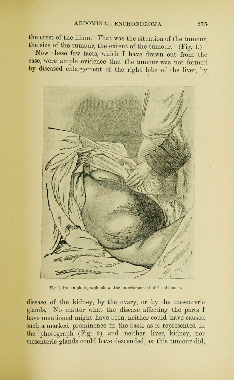 the crest of the ilium. That was the situation of the tumour, the size of the tumour, the extent of the tumour. (Fig. 1.) Now these few facts, which I have drawn out from the case, were ample evidence that the tumour was not formerl by diseased enlargement of the right lobe of the liver, by Fig. 1, from a photograph, shows the anterior aspect of tlie aljdomen. disease of the kidney, by the ovary, or by the mesenteric glands. No matter what the disease affecting the parts I have mentioned might have been, neither could have caused such a marked prominence in the back as is represented in the photograph (Fig. 2), and neither liver, kidney, nor mesenteric glands could have descended, as this tumour did.