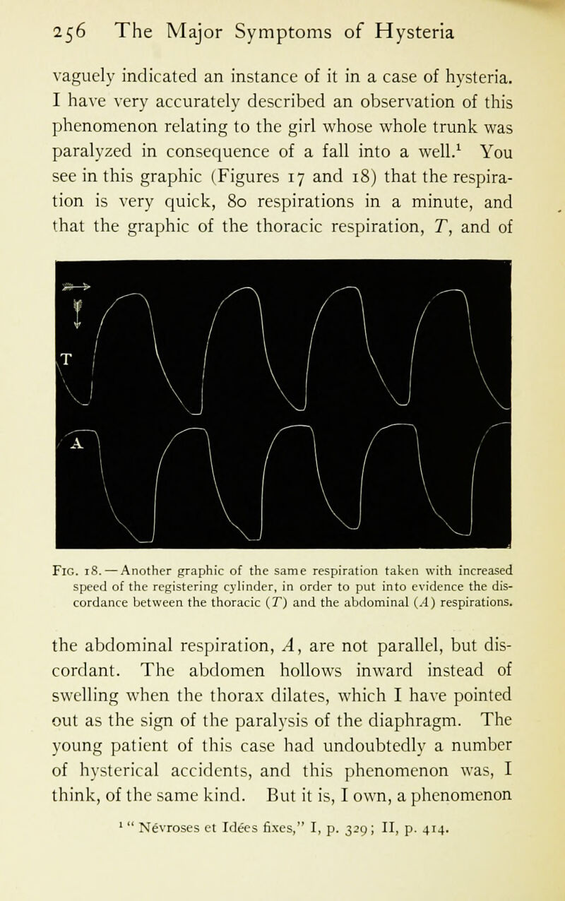 vaguely indicated an instance of it in a case of hysteria. I have very accurately described an observation of this phenomenon relating to the girl whose whole trunk was paralyzed in consequence of a fall into a well.1 You see in this graphic (Figures 17 and 18) that the respira- tion is very quick, 80 respirations in a minute, and that the graphic of the thoracic respiration, T, and of Fig. 18. — Another graphic of the same respiration taken with increased speed of the registering cylinder, in order to put into evidence the dis- cordance between the thoracic (T) and the abdominal (.4) respirations. the abdominal respiration, A, are not parallel, but dis- cordant. The abdomen hollows inward instead of swelling when the thorax dilates, which I have pointed out as the sign of the paralysis of the diaphragm. The young patient of this case had undoubtedly a number of hysterical accidents, and this phenomenon was, I think, of the same kind. But it is, I own, a phenomenon