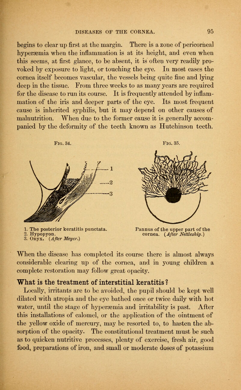 begins to clear up first at the margin. There is a zone of pericorneal hyperemia when the inflammation is at its height, and even when this seems, at first glance, to be absent, it is often very readily pro- voked by exposure to light, or touching the eye. In most cases the cornea itself becomes vascular, the vessels being quite fine and lying deep in the tissue. From three weeks to as many years are required for the disease to run its course. It is frequently attended by inflam- mation of the iris and deeper parts of the eye. Its most frequent cause is inherited syphilis, but it may depend on other causes of malnutrition. When due to the former cause it is generally accom- panied by the deformity of the teeth known as Hutchinson teeth. Fig. 34. Fig. 35. 1. The posterior keratitis punctata. 2. Hypopyon. 3. Onyx. {After Meyer.) Pannus of the upper part of the cornea. (After Nettleship.) When the disease has completed its course there is almost always considerable clearing up of the cornea, and in young children a complete restoration may follow great opacity. What is the treatment of interstitial keratitis ? Locally, irritants are to be avoided, the pupil should be kept well dilated with atropia and the eye bathed once or twice daily with hot water, until the stage of hyperemia and irritability is past. After this installations of calomel, or the application of the ointment of the yellow oxide of mercury, may be resorted to, to hasten the ab- sorption of the opacity. The constitutional treatment must be such as to quicken nutritive processes, plenty of exercise, fresh air, good food, preparations of iron, and small or moderate doses of potassium