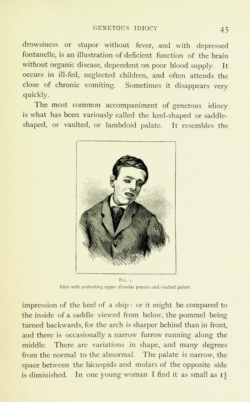 drowsiness or stupor without fever, and with depressed fontanelle, is an illustration of deficient function of the brain without organic disease, dependent on poor blood supply. It occurs in ill-fed, neglected children, and often attends the close of chronic vomiting. Sometimes it disappears very quickly. The most common accompaniment of genetous idiocy is what has been variously called the keel-shaped or saddle- shaped, or vaulted, or lambdoid palate. It resembles the *W ^gff ( >n0 MM rat \r\\.v f^Ws- ' Fio. i. Idiot with protruding upper alveolar process and vaulted palate. impression of the keel of a ship: or it might be compared to the inside of a saddle viewed from below, the pommel being turned backwards, for the arch is sharper behind than in front, and there is occasionally a narrow furrow running along the middle. There are variations in shape, and many degrees from the normal to the abnormal. The palate is narrow, the space between the bicuspids and molars of the opposite side is diminished. In one young woman I find it as small as ii