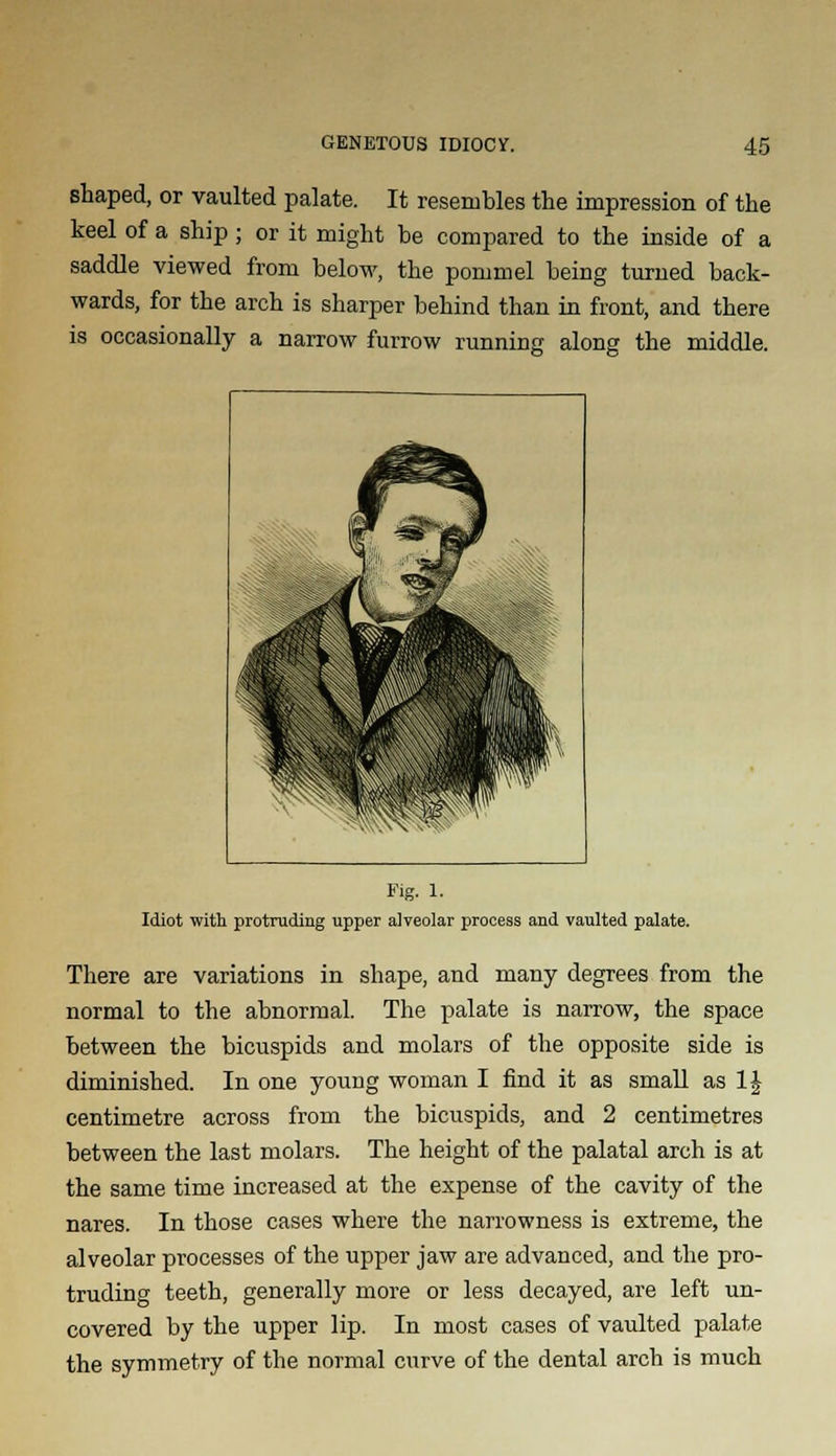 shaped, or vaulted palate. It resembles the impression of the keel of a ship; or it might be compared to the inside of a saddle viewed from below, the pommel being turned back- wards, for the arch is sharper behind than in front, and there is occasionally a narrow furrow running along the middle. P^ ■**» TBi n -sJj jm\ P^ L M If .S wsmBBB Fig. 1. Idiot with protruding upper alveolar process and vaulted palate. There are variations in shape, and many degrees from the normal to the abnormal. The palate is narrow, the space between the bicuspids and molars of the opposite side is diminished. In one young woman I find it as small as 1J centimetre across from the bicuspids, and 2 centimetres between the last molars. The height of the palatal arch is at the same time increased at the expense of the cavity of the nares. In those cases where the narrowness is extreme, the alveolar processes of the upper jaw are advanced, and the pro- truding teeth, generally more or less decayed, are left un- covered by the upper lip. In most cases of vaulted palate the symmetry of the normal curve of the dental arcb is much