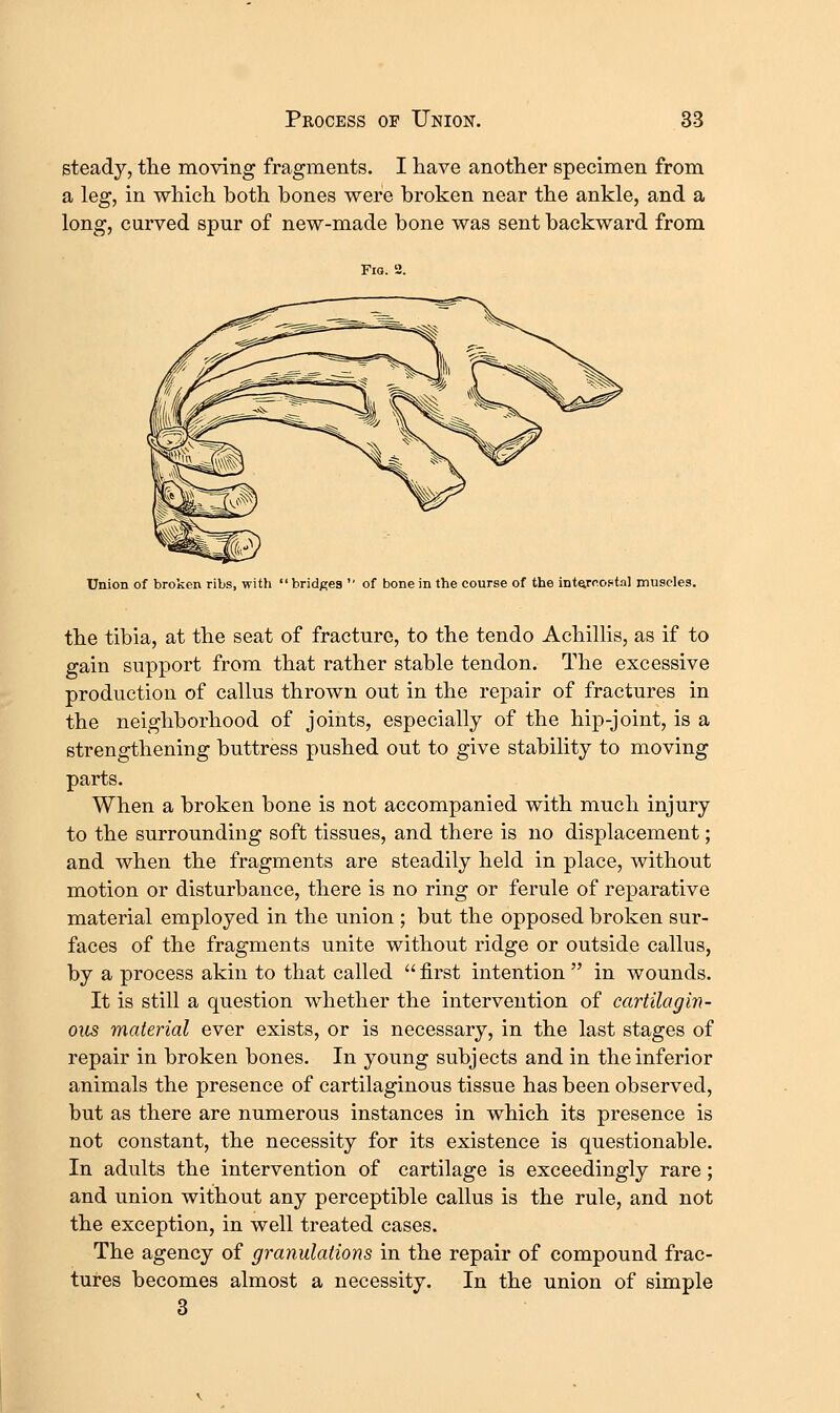 steady, tlie moving fragments. I have another specimen from a leg, in which both bones were broken near the ankle, and a long, curved spur of new-made bone was sent backward from Fio. 2. Union of broken ribs, with bridges  of bone in the course of the int^rrofttal muscles. the tibia, at the seat of fracture, to the tendo Achillis, as if to gain support from that rather stable tendon. The excessive production of callus thrown out in the repair of fractures in the neighborhood of joints, especially of the hip-joint, is a strengthening buttress pushed out to give stability to moving parts. When a broken bone is not accompanied with much injury to the surrounding soft tissues, and there is no displacement; and when the fragments are steadily held in place, without motion or disturbance, there is no ring or ferule of reparative material employed in the union ; but the opposed broken sur- faces of the fragments unite without ridge or outside callus, by a process akin to that called  first intention  in wounds. It is still a question whether the intervention of cartilagin- ous material ever exists, or is necessary, in the last stages of repair in broken bones. In young subjects and in the inferior animals the presence of cartilaginous tissue has been observed, but as there are numerous instances in which its presence is not constant, the necessity for its existence is questionable. In adults the intervention of cartilage is exceedingly rare; and union without any perceptible callus is the rule, and not the exception, in well treated cases. The agency of granulations in the repair of compound frac- tures becomes almost a necessity. In the union of simple 3