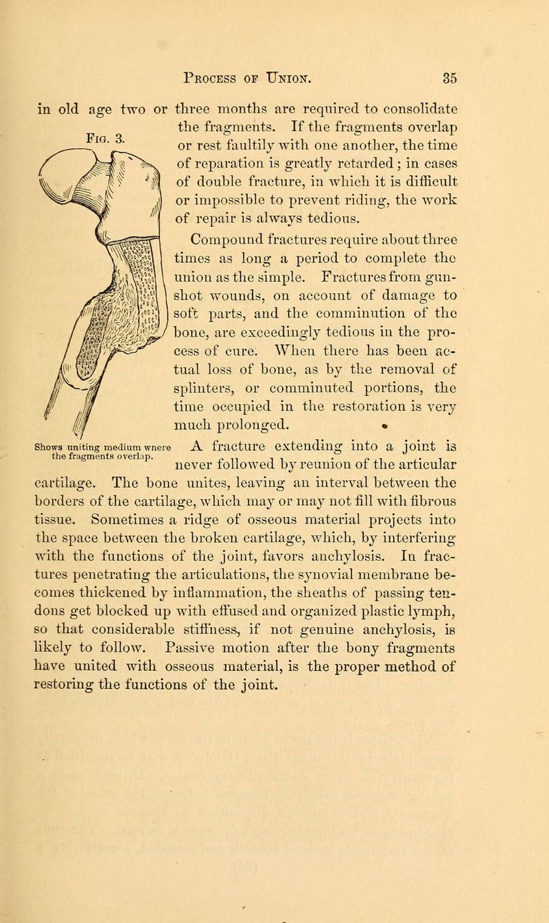 Fig Fractures from gun- of damage to in old age two or three months are required to consolidate the fragments. If the fragments overlap or rest faultily with one another, the time of reparation is greatly retarded; in cases of double fracture, in which it is difficult or impossible to prevent riding, the work of repair is always tedious. Compound fractures require about three times as long a period to complete the union as the simple shot wounds, on account soft parts, and the comminution of the bone, are exceedingly tedious in the pro- cess of cure. AVhen there has been ac- tual loss of bone, as by the removal of splinters, or comminuted portions, the time occupied in the restoration is very much prolonged. • A fracture extending into a joint is never followed by reunion of the articular cartilage. The bone unites, leaving an interval between the borders of the cartilage, which may or may not fill with fibrous tissue. Sometimes a ridge of osseous material projects into the space between the broken cartilage, which, by interfering with the functions of the joint, favors anchylosis. In frac- tures penetrating the articulations, the synovial membrane be- comes thickened by inflammation, the sheaths of passing ten- dons get blocked up with effused and organized plastic lymph, so that considerable stitfness, if not genuine anchylosis, is likely to follow. Passive motion after the bony fragments have united with osseous material, is the proper method of restoring the functions of the joint. Shows uniting medium wnere the fragments overlap.