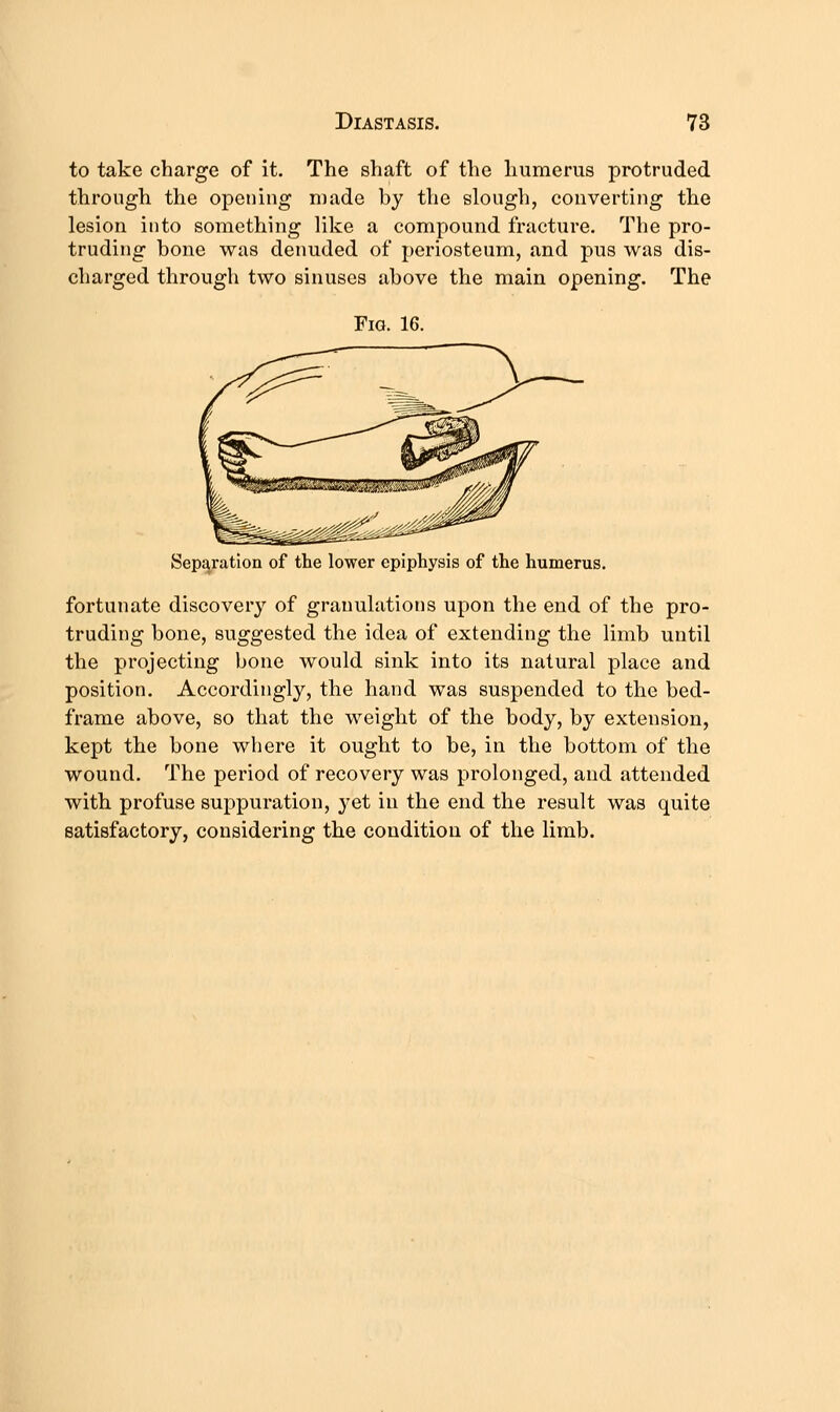 to take charge of it. The shaft of the humerus protruded through the opening made by the slough, converting the lesion into something like a compound fracture. The pro- truding bone was denuded of periosteum, and pus was dis- charged through two sinuses above the main opening. The Fig. 16. Separation of the lower epiphysis of the humerus. fortunate discovery of granulations upon the end of the pro- truding bone, suggested the idea of extending the limb until the projecting bone would sink into its natural place and position. Accordingly, the hand was suspended to the bed- frame above, so that the weight of the body, by extension, kept the bone where it ought to be, in the bottom of the wound. The period of recovery was prolonged, and attended with profuse suppuration, yet in the end the result was quite satisfactory, considering the condition of the limb.