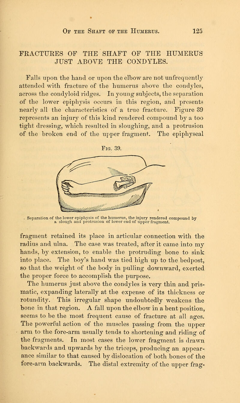 FRACTURES OF THE SHAFT OF THE HUMERUS JUST ABOVE THE COi^DYLES. Falls upon the hand or upon the elbow are not unfrequently attended with fracture of the humerus above the condyles, across the condyloid ridges. In young subjects, the separation of the lower epiphysis occurs in this region, and presents nearly all the characteristics of a true fracture. Figure 39 represents an injury of this kind rendered compound by a too tight dressing, which resulted in sloughing, and a protrusion of the broken end of the upper fragment. The epiphyseal Fig. 39. . Separation of the lower epiphysis of the humerus, the injury rendered compound by a slough and protrusion of lower end of upper fragment. fragment retained its place in articular connection with the radius and ulna. The case was treated, after it came into my hands, by extension, to enable the protruding bone to sink into place. The boy's hand was tied high up to the bedpost, so that the weight of the body in pulling downward, exerted the proper force to accomplish the purpose. The humerus just above the condyles is very thin and pris- matic, expanding laterally at the expense of its thickness or rotundity. This irregular shape undoubtedly weakens the bone in that region. A fall upon the elbow in a bent position, seems to be the most frequent cause of fracture at all ages. The powerful action of the muscles passing from the upper arm to the fore-arm usually tends to shortening and riding of the fragments. In most cases the lower fragment is drawn backwards and upwards by the triceps, producing an appear- ance similar to that caused by dislocation of both bones of the fore-arm backwards. The distal extremity of the upper frag-
