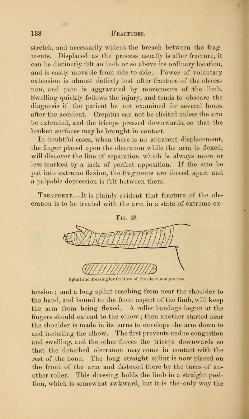 stretch, and necessarily widens the breach between the frag- ments. Displaced as the process usually is after fracture, it can be distinctly felt an inch or so above its ordinary location, and is easily movable from side to side. Power of voluntary extension is almost entirely lost after fracture of the olecra- non, and pain is aggravated by movements of the limb. Swelling quickly follows the injury, and tends to obscure the diagnosis if the' patient be not examined for several hours after the accident. Cre[>itus can not be elicited unless the arm be extended, and the triceps pressed downwards, so that the broken surfaces may be brought in contact. In doubtful cases, when there is no apparent displacement, the finger placed upon the olecranon while the arm is flexed, will discover the line of separation which is always more or less marked by a lack of perfect apposition. If the arm be put into extreme flexion, the fragments are forced apart and a palpable depression is felt between them. Treatment,—It is plainly evident that fracture of the ole- cranon is to be treated with the arm in a state of extreme ex- FiG. 48. Splint and dressing for fracture of the olecranon process. tension ; and a long splint reaching from near the shoulder to the hand, and bound to the front aspect of the limb, will keep the arm from being flexed. A roller bandage begun at the fingers should extend to the elbow ; then another started near the shoulder is made in its turns to envelope the arm down to and including the elbow. The first prevents undue congestion and swelling, and the other forces the triceps downwards so that the detached olecranon may come in contact with the rest of the bone. The long straight splint is now placed on the front of the arm and fastened there by the turns of an- other roller. This dressing holds the limb in a straight posi- tion, which is somewhat awkward, but it is the only way the