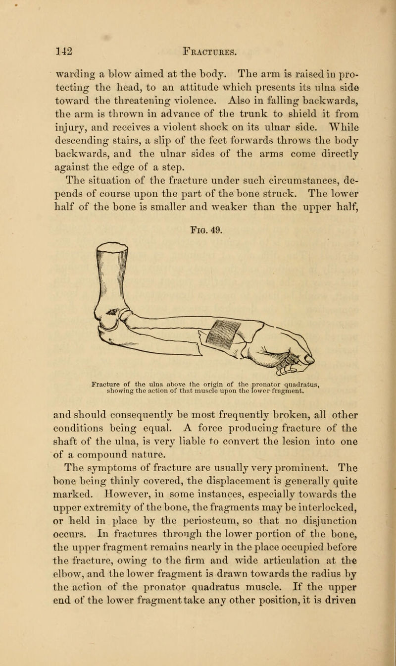 warding a blow aimed at the body. The arm is raised in pro- tecting the head, to an attitude which presents its ulna side toward the threatening violence. Also in falling backwards, the arm is thrown in advance of the trunk to shield it from injury, and receives a violent shock on its ulnar side. While descending stairs, a slip of the feet forwards throws the body backwards, and the ulnar sides of the arms come directly against the edge of a step. The situation of the fracture under such circumstances, de- pends of course upon the part of the bone struck. The lower half of the bone is smaller and weaker than the upper half, Fig. 49. Fracture of the ulna above the origin of the pronator quadratus, showing the action of that muscle upon the lower fragment. and should consequently be most frequently broken, all other conditions being equal. A force producing fracture of the shaft of the ulna, is very liable to convert the lesion into one of a compound nature. The symptoms of fracture are usually very prominent. The bone being thinly covered, the displacement is generally quite marked. However, in some instances, especially towards the upper extremity of the bone, the fragments may be interlocked, or held in place by the periosteum, so that no disjunction occurs. In fractures through the lower portion of the bone, the upper fragment remains nearly in the place occupied before the fracture, owing to the tirm and wide articulation at the elbow, and the lower fragment is drawn towards the radius by the action of the pronator quadratus muscle. If the upper end of the lower fragment take any other position, it is driven