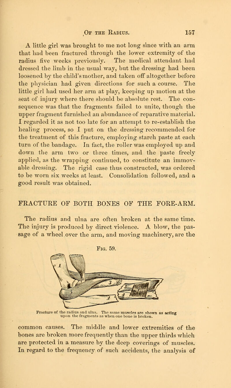 A little girl was brought to me not long since with an arm that had been fractured througli the lower extremity of the radius five weeks previously. The medical attendant had dressed the limb in the usual way, but the dressing had been loosened by the child's mother, and taken off altogether before the physician had given directions for such a course. The little girl had used her arm at play, keeping up motion at the seat of injury where there should be absolute rest. The con- sequence was that the fragments failed to unite, though the upper fragment furnished an abundance of reparative material. I regarded it as not too late for an attempt to re-establish the healing process, so I put on the dressing recommended for the treatment of this fracture, employing starch paste at each turn of the bandage. In fact, the roller was employed up and down the arm two or three times, and the paste freely applied, as the wrapping continued, to constitute an immov- able dressing. The rigid case thus constructed, was ordered to be worn six weeks at least. Consolidation followed, and a good result was obtained. FRACTURE OF BOTH BONES OF THE FORE-ARM. The radius and ulna are often broken at the same time. The injury is produced by direct violence. A blow, the pas- sage of a wheel over the arm, and moving machinery, are the Fig. 59. Fracture of the radius and ulna. The same muscles are shown as acting upon the fragments as when one bone is broken. common causes. The middle and lower extremities of the bones are broken more frequently than the upper thirds which are protected in a measure by the deep coverings of muscles. In regard to the frequency of such accidents, the analysis of