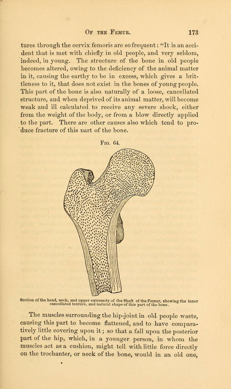 tures through the cervix femoris are so frequent: It is an acci- dent that is met with chiefly in old people, and very seldom, indeed, in young. The structure of the bone in old people becomes altered, owing to the deficiency of the animal matter in it, causing the earthy to be in excess, which gives a brit- tleness to it, that does not exist in the bones of young people. This part of the bone is also naturally of a loose, cancellated structure, and when deprived of its animal matter, will become weak and ill calculated to receive any severe shock, either from the weight of the body, or from a blow directly applied to the part. There are other causes also which tend to pro- duce fracture of this Dart of the bone. Fig. 64. Section of the head, neck, and upper extremity of the Shaft of the Femur, showing the inner cancellated texture, and natural shape of this part of the bone. The muscles surrounding the hip-joint in old people waste, causing this part to become flattened, and to have compara- tively little covering upon it; so that a fall upon the posterior part of the hip, which, in a younger person, in whom the muscles act as a cushion, might tell with little force directly on the trochanter, or neck of the bone, would in an old one,