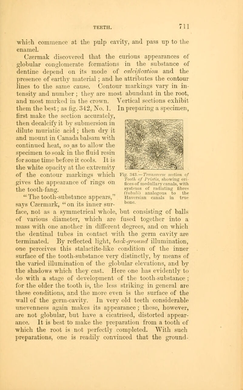 wliicli commence at the pulp cavity, and pass up to tlie enamel. Czermak discovered that the curious appearances of globular conglomerate formations in the substance of dentine depend on its mode of calcification and the presence of earthy material; and he attributes the contour lines to the same cause. Contour markings vary in in- tensity and number; they are most abundant in the root, and most marked in the crown. Vertical sections exhibit them the best; as fig. 342, ISTo. 1. In preparing a specimen, first make the section accurately, then decalcify it by submersion in dilute muriatic acid; then dry it and mount in Canada balsam with continued heat, so as to allow the specimen to soak in the fluid resin for some time before it cools. It is the white opacity at the extremity of the contour markings which gives the appearance of rings on the tooth-fang. The tooth-substance appears, says Czermark,  on its inner sur- face, not as a symmetrical whole, but consisting of balls of various diameter, which are fused together into a mass w^ith one another in different degrees, and on which the dentinal tubes in contact with the germ cavity are terminated. By reflected light, hack-ground illumination, one perceives this stakictite-like condition of the inner surface of the tooth-substance very distinctly, by means of the varied illumination of the globular elevations, and by the shadows which they cast. Here one has evidently to do with a stage of development of the tooth-substance ; for the older the tooth is, the less striking in general are these conditions, and the more even is the surface of the wall of the germ-cavity. In very old teeth considerable unevenness again makes its appearance; these, however, are not globular, but have a cicatrised, distorted appear- ance. It is best to make the preparation from a tooth of which the root is not perfectly completed. With such preparations, one is readily convinced that the ground- Fig. 343.— Transverse, section of Tooth of Pristis, showing ori- fices of medullary canals, with systeiiis of radiating fibres (tuhuli) analogous to the Haversian canals in true bone.
