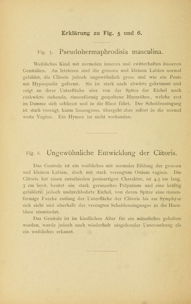 Fig. 5. Pseudohermaphrodisia masculina. Weibliches Kind mit normalen inneren und zwitterhalten äusseren Genitalien. An letzteren sind die grossen und kleinen Labien normal gebildet, die Clitoris jedoch ungewöhnlich gross und wie ein Penis mit Hypospadie geformt. Sie ist stark nach abwärts gekrümmt und zeigt an ihrer Unterfläche eine von der Spitze der Eichel nach rückwärt- /ichende, rinnenförmig gespaltene Harnröhre, welche erst im Damme sich schhesst und in die Blase führt. Der Scheideneingang i-t stark verengt, kaum linsengross, übergeht aber sofort in die normal weite Vagina. Ein Hymen ist nicht vorhanden. Fig. 6. Ung-ewohnliche Entwicklung der Clitoris. Das Genitale ist ein weibliches mit normaler Bildung der grossen und kleinen Labien, doch mit stark verengtem Ostium vaginae. Die Clitoris hat einen entschieden penisartigen Charakter, ist 4,5 cm lang, 3 cm breit, besitzt ein stark gerunzelte.- Präputium und eine kräftig gebildete, jedoch undurchbohrte Eichel, von deren Spitze eine rinnen- förmige Furche entlang der Unterfläche der Clitoris bis zur Symphyse >ich zieht und oberhalb des verengten Scheideneinganges in die Harn- blase einmündet. Das Genitale ist im kindlichen Alter für ein männliches gehalten worden, wurde jedoch nach wiederholt eingehender Untersuchung als ein weibliches erkannt.