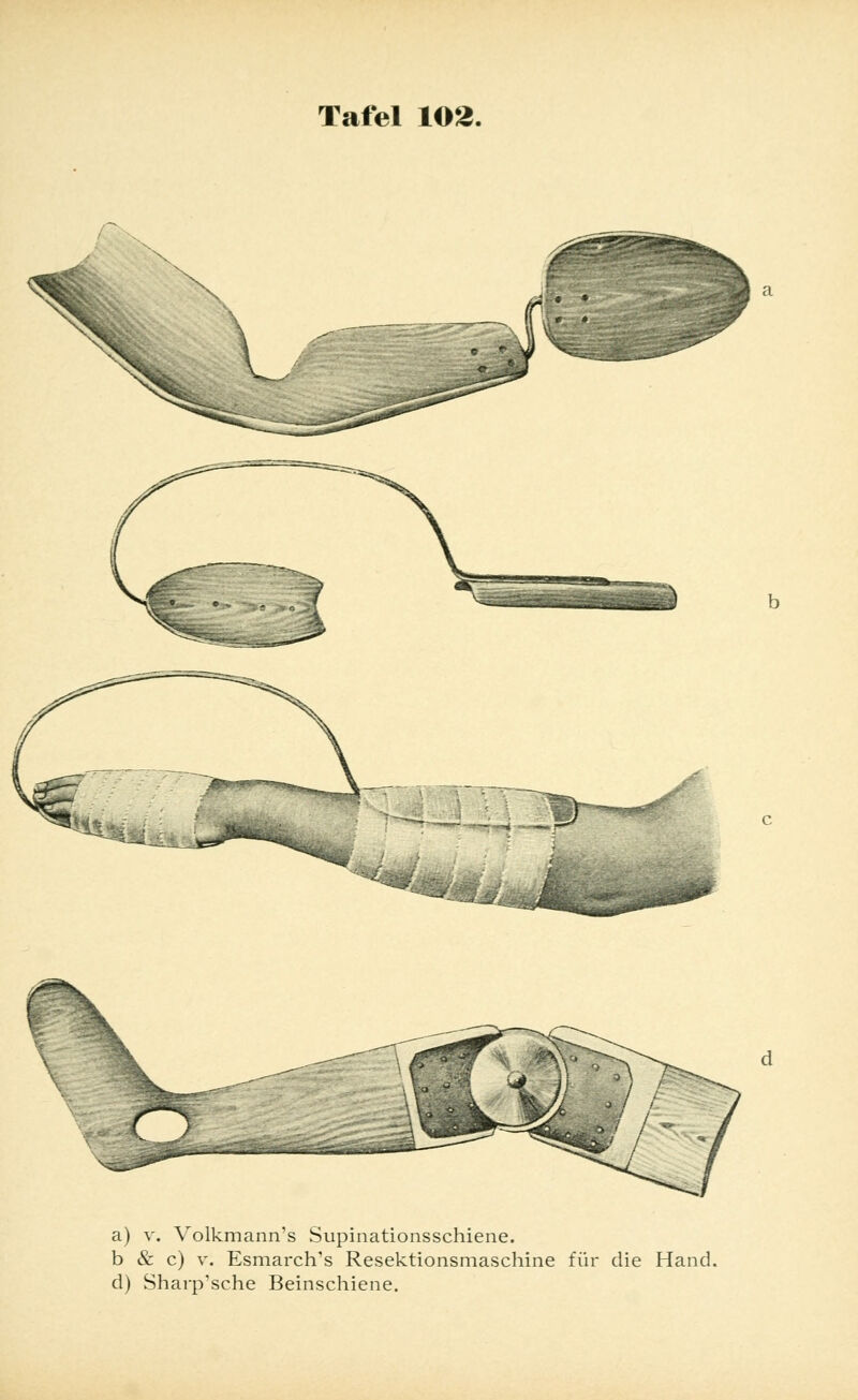<*s a) v. Volkmann's Supinationsschiene. b & c) v. Esmarch's Resektionsmaschine für die Hand. d) Sharp'sche Beinschiene.