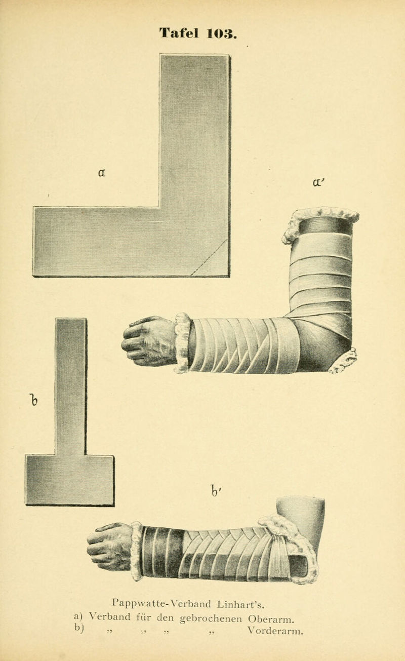 a' hä^Mäimmm &?■*&- Pappwatte-Verband Linhart's. a) Verband für den gebrochenen Oberarm. bJ » :j .•> „ Vorderarm.