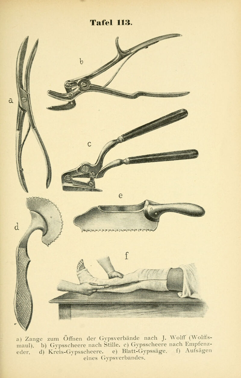 a) Zange zum Öffnen der Gipsverbände nach J. Wolff (Wolffs- maul). b) Gvpsscheere nach Stille, c) Gypsscheere nach Empfenz- eder. d) Kreis-Gypsscheere. e) Blatt-Gypssäge. f) Aufsägen eines Gipsverbandes.