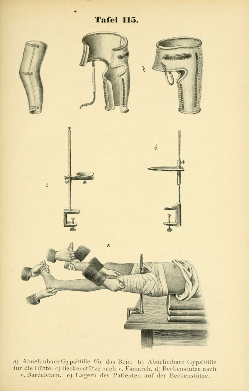 a) Abnehmbare Gypshülle für das Bein, b) Abnehmbare Gypshülle für die Hüfte, c) Beckenstütze nach v. Esmarch. d) Beckenstütze nach v. Bardeleben, e) Lagern des Patienten auf der Beckenstütze.