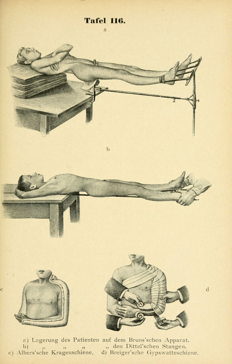 , / ir a) Lagerung des Patienten auf dem Bruns'schen Apparat. b) ,. „ „ ., den DitteFschen Stangen. c) Albers'sehe Kragenschiene. d) Breiger'sche Gypswatteschiene.