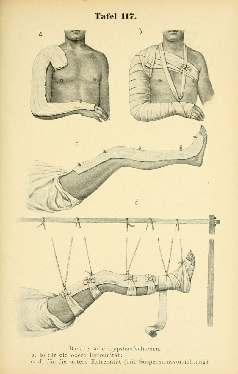 y ^Uii>****^^ r*^<;. h J3.-V« ! B e e 1 y sehe Gypshanfschienen. a, b) für die obere Extremität; c, d) für die untere Extremität (mit Suspensionsvorrichtung).