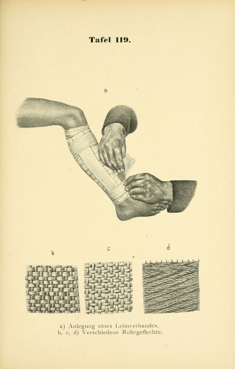 a) Anlegung eines Leimverbandes. b. c. d) Verschiedene Rohrgeflechte.