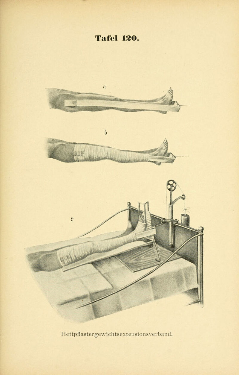 Tafel 120. Heftpflastergewichtsextensionsverband.