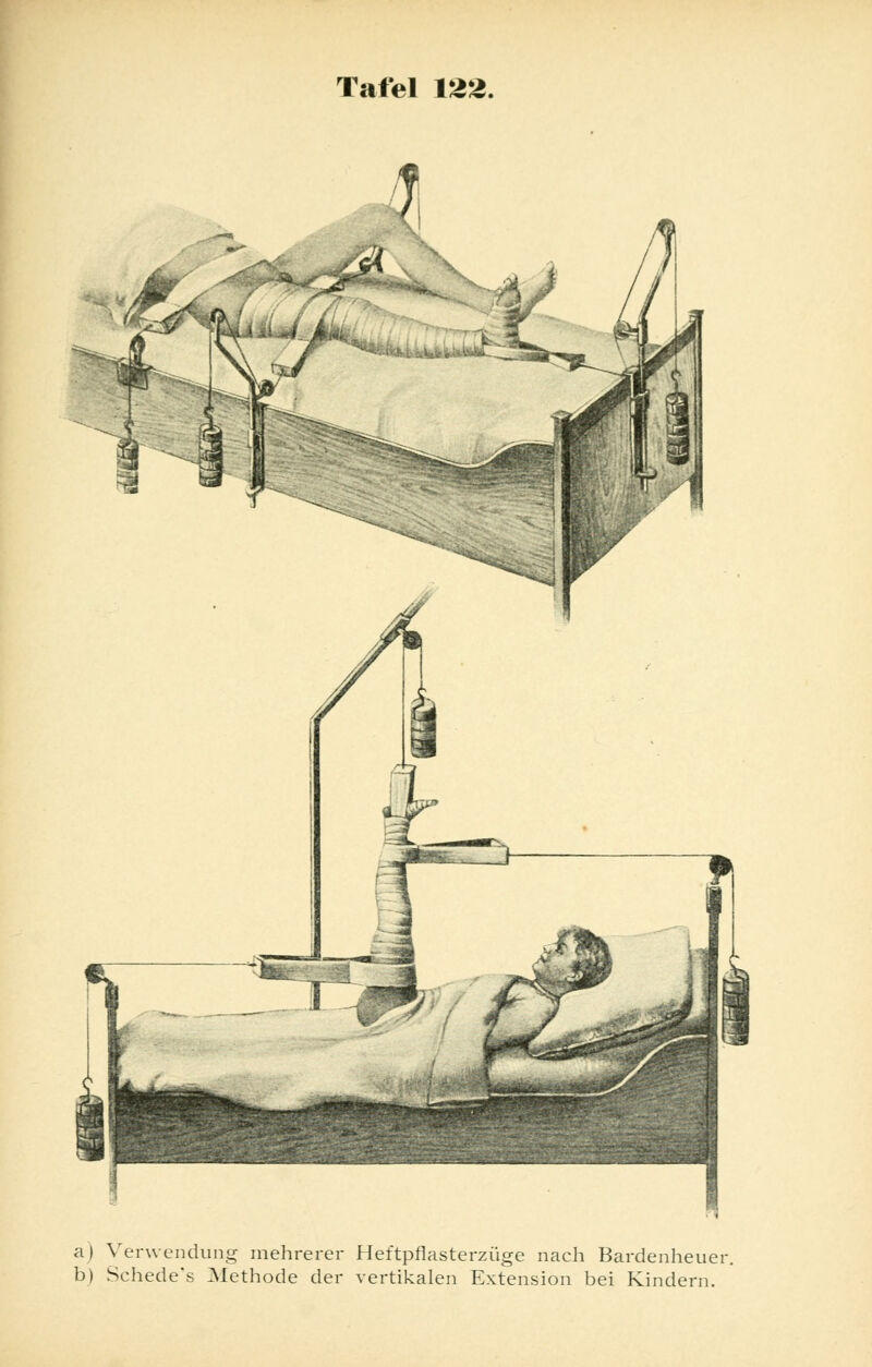 a) Verwendung mehrerer Heftpflasterzüge nach Bardenheuer b) Schede's Methode der vertikalen Extension bei Kindern.