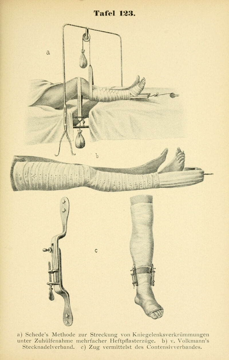 s.a.. a) Schede's Methode zur Streckung von Kniegelenksverkrümmungen unter Zuhülfenahme mehrfacher Heftpflasterzüge, b) v. Volkmann's