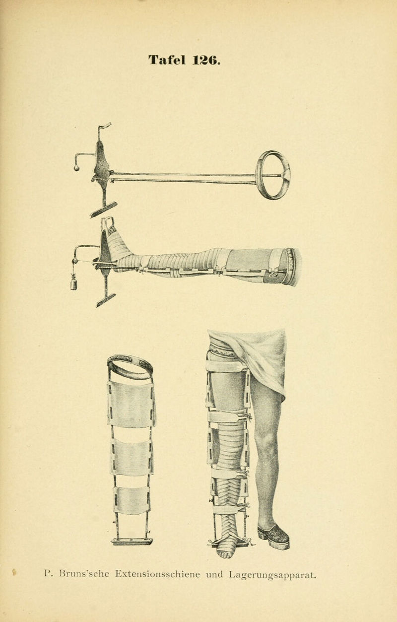 i l: c r Ä] S i i P. Bruns'sche Extensionsschiene und Lagerungsapparat.