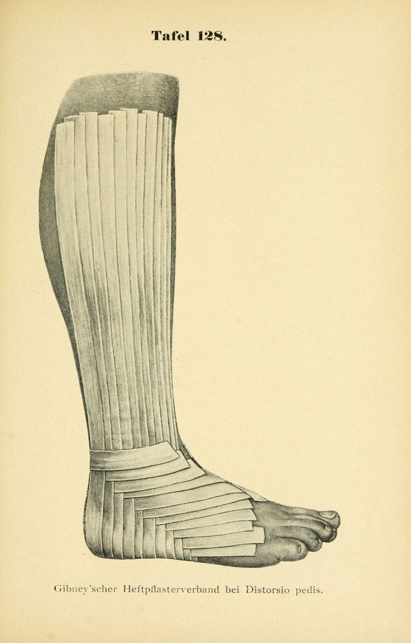 Gibneyscher Heftpilasterverband bei Distorsio pedis.