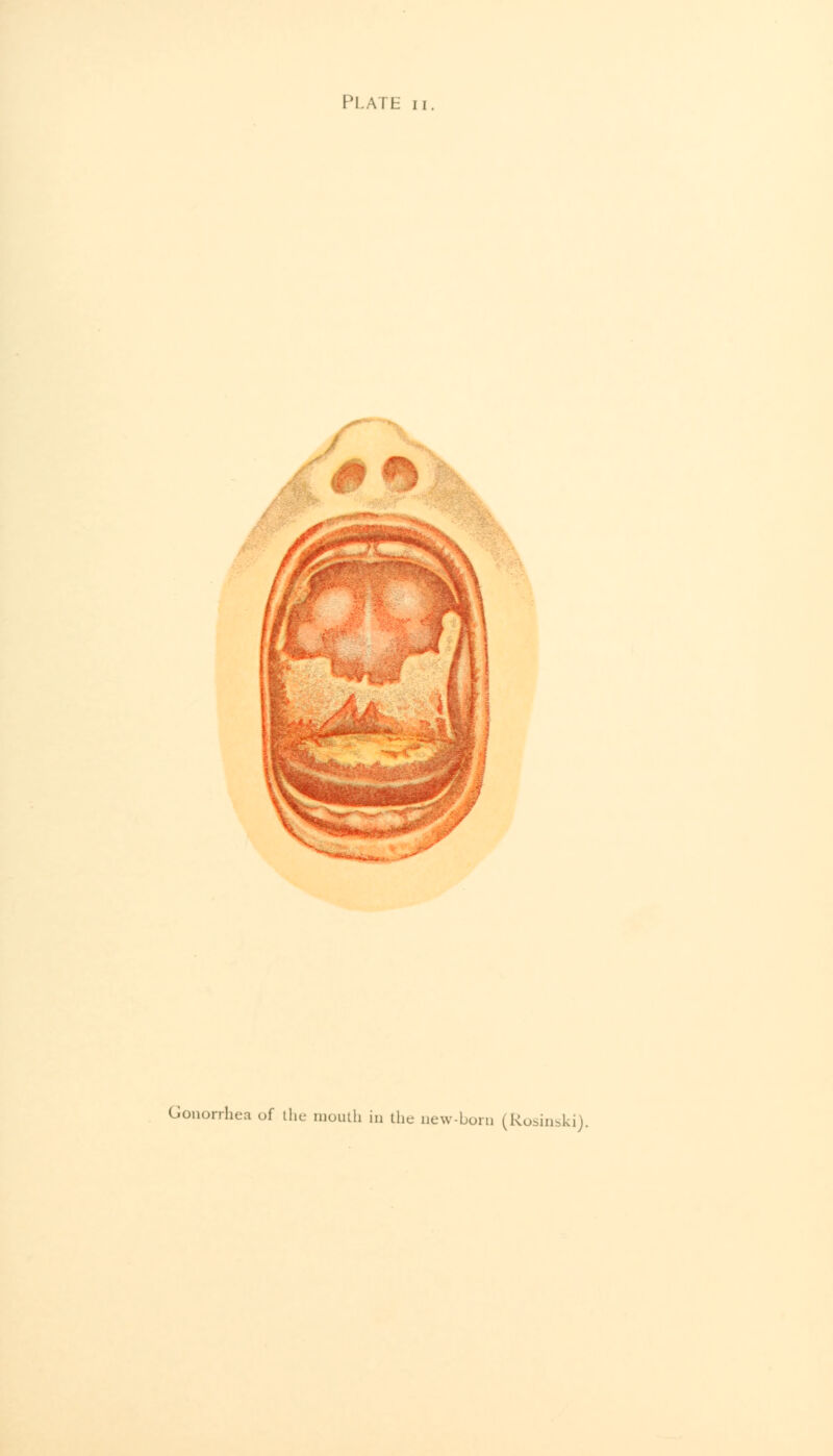 PLATE Gonorrhea of the mouth in the new-born (Rosinski).