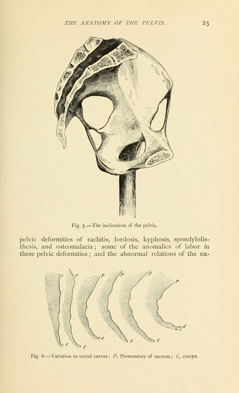 Fig. 5.—The inclination of the pelvis. pelvic deformities of rachitis, lordosis, kyphosis, spondylolis- thesis, and osteomalacia ; some of the anomalies of labor in these pelvic deformities ; and the abnormal relations of the ex- ^c %^ V,,, * r ^ c Fig. 6.—Variation in sacral curves: P. Promontory of sacrum; Cy coccyx.