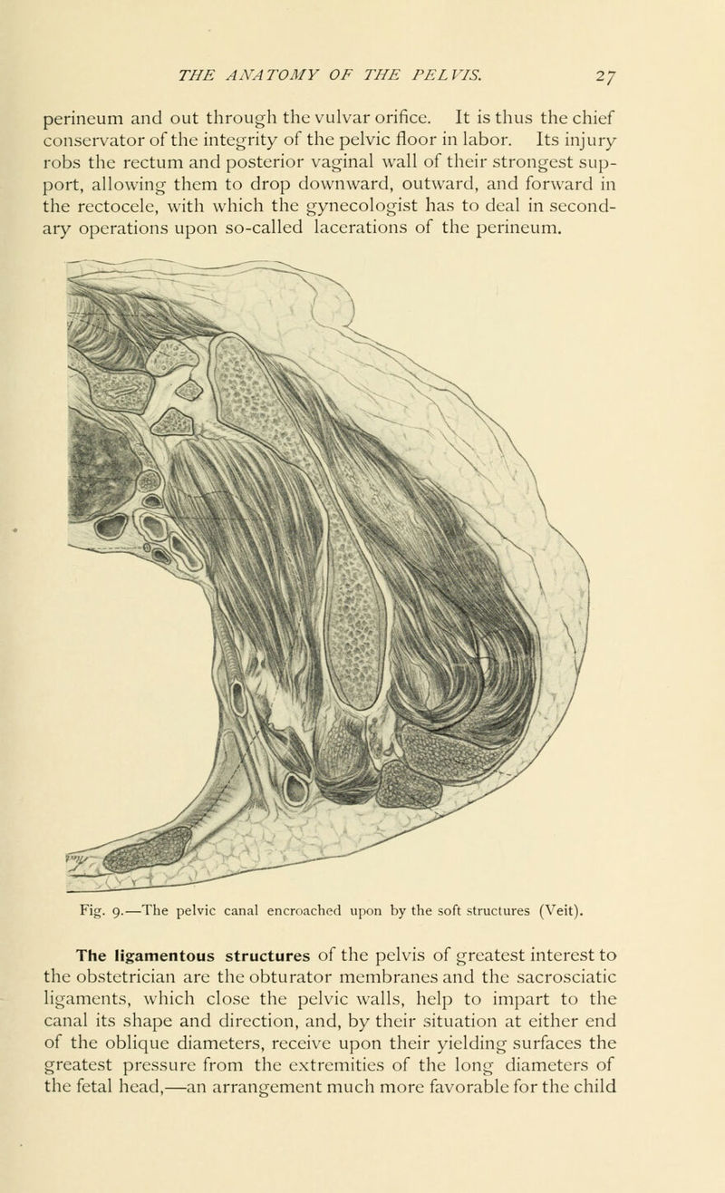 *7 perineum and out through the vulvar orifice. It is thus the chief conservator of the integrity of the pelvic floor in labor. Its injury robs the rectum and posterior vaginal wall of their strongest sup- port, allowing them to drop downward, outward, and forward in the rectocele, with which the gynecologist has to deal in second- ary operations upon so-called lacerations of the perineum. Fig- 9-—The pelvic canal encroached upon by the soft structures (Veit). The ligamentous structures of the pelvis of greatest interest to the obstetrician are the obturator membranes and the sacrosciatic ligaments, which close the pelvic walls, help to impart to the canal its shape and direction, and, by their situation at either end of the oblique diameters, receive upon their yielding surfaces the greatest pressure from the extremities of the long diameters of the fetal head,—an arrangement much more favorable for the child