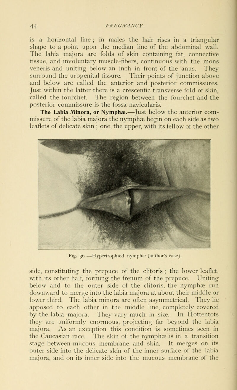is a horizontal line ; in males the hair rises in a triangular shape to a point upon the median line of the abdominal wall. The labia majora are folds of skin containing fat, connective tissue, and involuntary muscle-fibers, continuous with the mons veneris and uniting below an inch in front of the anus. They surround the urogenital fissure. Their points of junction above and below are called the anterior and posterior commissures. Just within the latter there is a crescentic transverse fold of skin, called the fourchet. The region between the fourchet and the posterior commissure is the fossa navicularis. The Labia Minora, or Nymphae.—Just below the anterior com- missure of the labia majora the nymphae begin on each side as two leaflets of delicate skin ; one, the upper, with its fellow of the other Fig. 36.—Hypertrophied nymph* (author's case). side, constituting the prepuce of the clitoris ; the lower leaflet, with its other half, forming the frenum of the prepuce. Uniting below and to the outer side of the clitoris, the nymphae run downward to merge into the labia majora at about their middle or lower third. The labia minora are often asymmetrical. They lie apposed to each other in the middle line, completely covered by the labia majora. They vary much in size. In Hottentots they are uniformly enormous, projecting far beyond the labia majora. As an exception this condition is sometimes seen in the Caucasian race. The skin of the nymphae is in a transition stage between mucous membrane and skin. It merges on its outer side into the delicate skin of the inner surface of the labia majora, and on its inner side into the mucous membrane of the