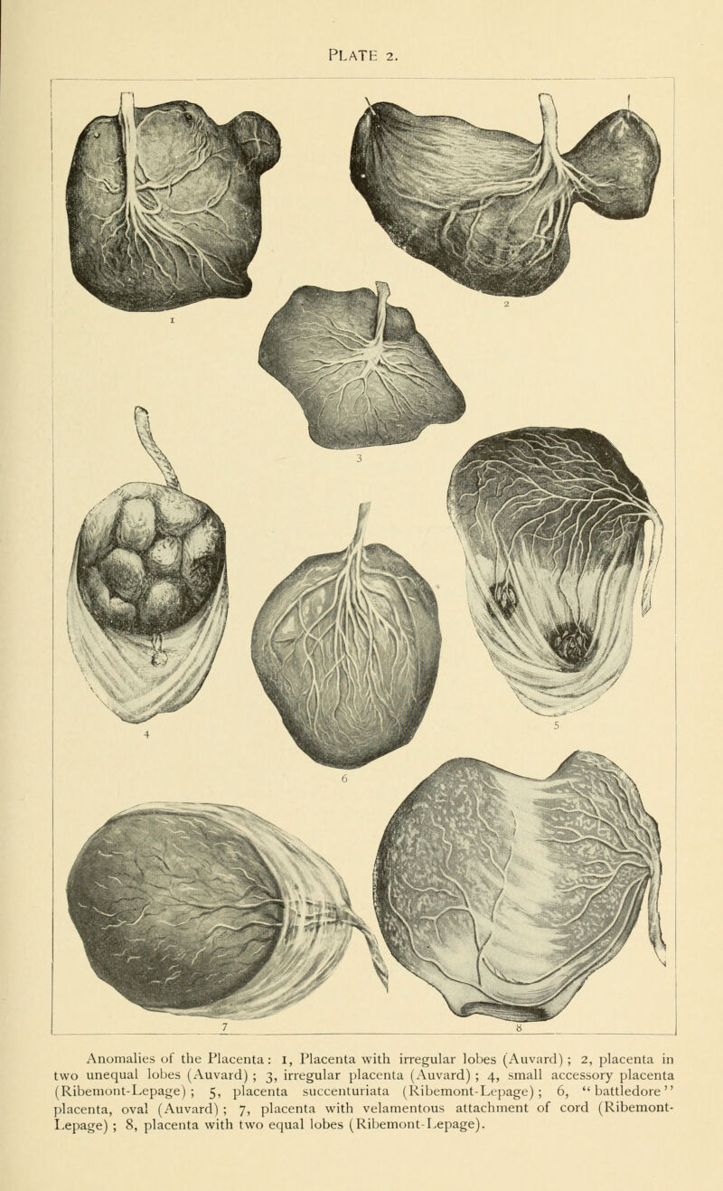 Anomalies of the Placenta: I, Placenta with irregular lobes (Auvard) ; 2, placenta in two unequal lobes (Auvard) ; 3, irregular placenta (Auvard) ; 4, small accessory placenta (Ribemont-Lepage) ; 5, placenta succenturiata (Ribemont-Lepage); 6, battledore placenta, oval (Auvard) ; 7, placenta with velamentous attachment of cord (Ribemont- Lepage) ; 8, placenta with two equal lobes (Ribemont-Lepage).