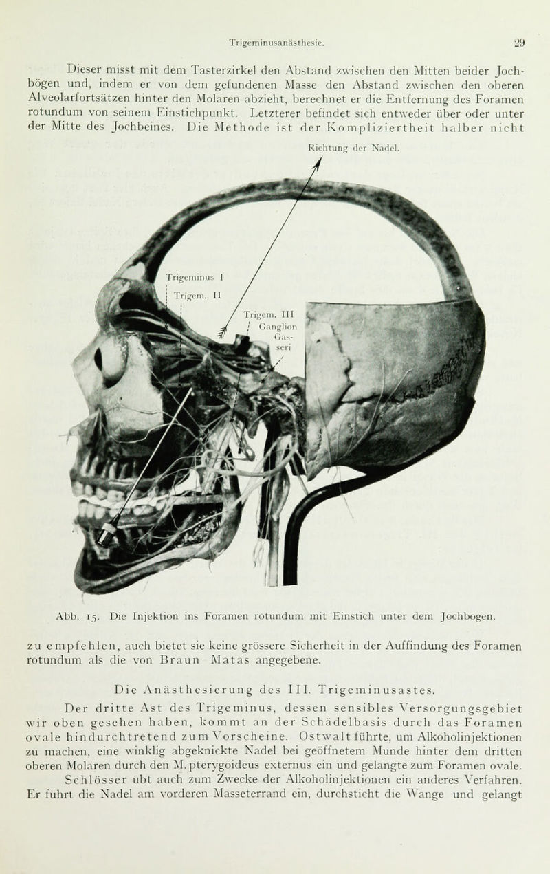 Dieser misst mit dem Tasterzirkel den Abstand zwischen den Mitten beider Joch- bögen und, indem er von dem gefundenen Masse den Abstand zwischen den oberen Alveolarfortsätzen hinter den Molaren abzieht, berechnet er die Entfernung des Foramen rotundum von seinem Einstichpunkt. Letzterer befindet sich entweder über oder unter der Mitte des Jochbeines. Die Methode ist der Kompliziertheit halber nicht Richtung der Nadel. Abb. 15. Die Injektion ins Foramen rotundum mit Einstich unter dem Jochbogen. ZU empfehlen, auch bietet sie keine grössere Sicherheit in der Auffindung des Foramen rotundum als die von Braun Matas angegebene. Die .Anästhesierung des III. Trigeminusastes. Der dritte .Ast des Trigeminus, dessen sensibles Versorgungsgebiet wir oben gesehen haben, kommt an der Schädelbasis durch das Foramen ovale hindurchtretend zu m \'orscheine. Ostwalt führte, um Alkoholinjektionen zu machen, eine winklig abgeknickte Nadel bei geöffnetem Munde hinter dem dritten oberen Molaren durch den M. pterygoideus externus ein und gelangte zum Foramen ovale. Schlösser übt auch zum Zwecke der Alkoholinjektionen ein anderes Verfahren. Er führt die Nadel am vorderen Masseterrand ein, durchsticht die Wange und gelangt