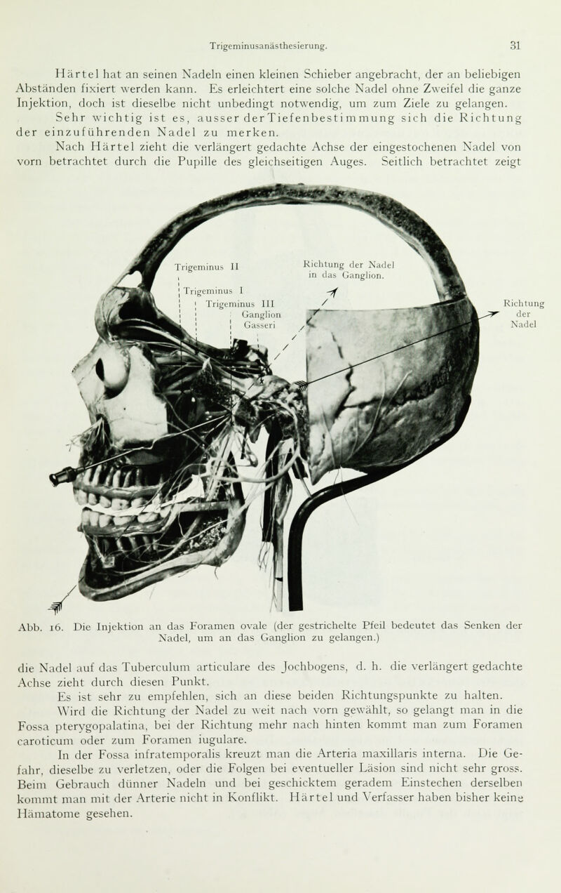 Härtel hat an seinen Nadeln einen kleinen Schieber angebracht, der an beliebigen Abständen fixiert werden kann. Es erleichtert eine solche Nadel ohne Zweifel die ganze Injektion, doch ist dieselbe nicht unbedingt notwendig, um zum Ziele zu gelangen. Sehr wichtig ist es, a u s s e r d e r T i e f e n b e s t i m m u n g sich die Richtung der einzuführenden Nadel zu merken. Nach Härtel zieht die verlängert gedachte Achse der eingestochenen Nadel von vorn betrachtet durch die Pupille des gleichseitigen Auges. Seitlich betrachtet zeigt RichUing der Nadel Abb. i6. Die Injektion an das Foramen ovale (der gestrichelte Pfeil bedeutet das Senken der Xadcl, um an das Ganglion zu gelangen.) die Nadel auf das Tuberculum articulare des Jochbogens, d. h. die verlängert gedachte Achse zieht durch diesen Punkt. Es ist sehr zu empfehlen, sich an diese beiden Richtungspunkte zu halten. Wird die Richtung der Nadel zu weit nach vorn gewählt, so gelangt man in die Fossa pterygopalatina, bei der Richtung mehr nach hinten kommt man zum Foramen caroticum oder zum Foramen iugulare. In der Fossa infratemporalis kreuzt man die Arteria maxillaris interna. Die Ge- fahr, dieselbe zu \-erletzen, oder die Folgen bei eventueller Läsion sind nicht sehr gross. Beim Gebrauch dünner Nadeln und bei geschicktem geradem Einstechen derselben konnnt man mit der Arterie nicht in Konflikt. Härtel und A'erfasser haben bisher keine Hämatome gesehen.