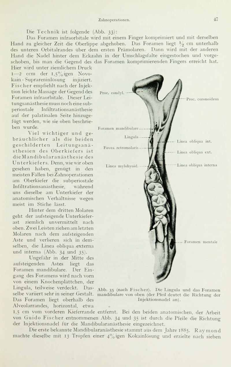 Proc. conclvl. ^V  Proc. coronoideus *■ Foramen mandibulare Lingula Fovea retromolaris Linea mvlohvoid. Linea oljliqua int. - Linea oliliqua ext. 'Linea obliqua interna Die Technik ist folgende (Abb. ^j): Das Foramen infraorbitale wird mit einem Finger komprimiert und mit derselben Hand zu gleicher Zeit die Oberlippe abgehoben. Das Foramen liegt ^ ■> cm unterhalb des unteren Orbitalrandes über dem ersten Prämolaren. Dann wird mit der anderen Hand die Nadel hinter dem Eckzahn in der Umschlagsfalte eingestochen und vorge- schoben, bis man die Gegend des das Foramen komprimierenden Fingers erreicht hat. Hier wird unter ziemlichem Druck I—2 ccm der 1,5% igen Novo- kain - Su]jrareninlösung mjiziert. Fischer empfiehlt nach der Injek- tion leichte Massage der Gegend des Foramen infraorbitale. Dieser Dei- tungsanästhesie muss noch eine sub- periostale Infiltrationsanästhesie auf der palatinalen Seite hinzuge- fügt werden, wie sie oben beschrie- ben wurde. \'iel \\ichtiger und ge- bräuchlicher als die beiden geschilderten Leitungsanä- sthesien des Oberkiefers ist dieMandibularanästhesie des Unterkiefers. Denn, \\iewir oben gesehen haben, genügt in den meisten Fällen bei Zahn(j| )erationen am Oberkiefer die subperiostale Infiltrationsanästhesie, während uns dieselbe am Unterkiefer der anatomischen \'erhältnisse wegen U^ meist im Stiche lasst. Hinter dem dritten Molaren geht der aufsteigende Unterkiefer- ast ziemlich unvermittelt nach oben. Zwei Leisten ziehen am letzten Molaren nach dem aufsteigenden Aste und \-erlieren sich in dem- selben, die Linea obliqua externa und interna (Abb. 34 und ^^). Ungefähr in der Mitte des aufsteigenden .^stes liegt das Foramen mandibulare. Der Ein- g.tng des Foramens wird nach vorn von einem Knochenplattchen, der Lingula, teilweise verdeckt. Das- selbe N'ariiert sehr in seiner Gestalt. Das Foramen liegt oberhalb des Alveolarrandes, horizontal, etwa 1,5 cm \oni vorderen Kieferrande entfernt. Bei den beiden anatomischen, der .Arbeit von Guitlo Fischer entnommenen Abb. 34 und 35 ist durch die Pfeile die Richtung der Injektionsnadel für die Mandibularanästhesie eingezeichnet. Die erste bekannte Mandibularanästhesie stammt aus dem Jahre 1885. Raymond machte dieselbe mit 13 Tropfen einer 4'^oigen Kokainlösung und erzielte nach sieben Foramen mentale 4\ Abb. 35 (nach Fischer). Die Lingula und das Foramen mandibulare von oben (der Pfeil deutet die Richtung der Injektionsnadel an).