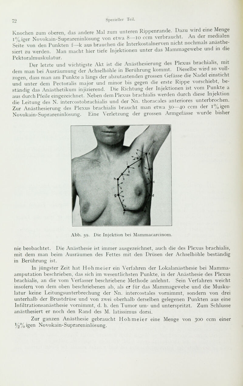 Knochen zum oberen, das andere Mal zum unteren Rippenrande. Dazu ^vlrd eme Menge l%iger Novokain-Suprareninlösung von etwa 8-10 ccm verbraucht. An der medialen Seite von den Punkten f-k aus brauchen die Interkostahierven nicht nochmals anästhe- siert zu werden. Man macht hier tiefe hijektionen unter das Mammagewebe und in die Pektoralmuskulatur. Der letzte und wichtigste Akt ist die Anästhesierung des Plexus brachialis, mit dem man bei Ausräumung der Achselhöhle in Berührung kommt. Dieselbe wird so voll- zogen, dass man am Punkte a längs der abzutastenden grossen Gefässe die Nadel einsticht und unter dem Pectoralis major und minor bis gegen die erste Rippe vorschiebt, be- ständig das Anästhetikum injizierend. Die Richtung der Injektionen ist vom Punkte a aus durch Pfeile eingezeichnet. Neben dem Plexus brachialis werden durch diese Injektion die Leitung des N. intercostobrachialis und der Nn. thoracales anteriores unterbrochen. Zur Anästhesierung des Plexus brachialis braucht man etwa 30—40 ccm der l%igen Novokain-Suprareninlösung. Eine X'erletzung der grossen Armgefässe wurde bisher Abb. 59. Die Injektion bei Mammacarcinom. nie beobachtet. Die Anästhesie ist immer ausgezeichnet, auch die des Plexus brachialis, mit dem man beim Ausräumen des Fettes mit den Drüsen der Achselhöhle beständig in Berührung ist. In jüngster Zeit hat Hohmeier ein \'erfahren der Lokalanästhesie bei Mamma- amputation beschrieben, das sich im wesentlichsten Punkte, in der Anästhesie des Plexus brachialis, an die vom \'erfasser beschriebene Methode anlehnt. Sein Verfahren weicht insofern von dem oben beschriebenen ab, als er für das Mammagewebe und die Musku- latur keine Leitungsunterbrechung der Nn. intercostales vornimmt, sondern von drei unterhalb der Brustdrüse und von zwei oberhalb derselben gelegenen Punkten aus eine Infiltrationsanästhesie vornimmt, d. h. den Tumor um- und unterspritzt. Zum Schlüsse anästhesiert er noch den Rand des M. latissimus dorsi. Zur ganzen Anästhesie gebraucht Hohmeier eine Menge von 300 ccm einer %% igen Novokain- Suprareninlösung.