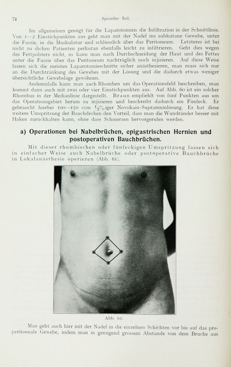 Im allgemeinen genügt für die Laparotomien die Infiltration in der Schnittlinie. \'on I—2 Einstichpunkten aus geht man mit der Nadel ins subkutane Gewebe, vmter die Faszie, in die Muskulatur und schliesslich über das Peritoneum. Letzteres ist bei nicht zu dicken Patienten perkutan ebenfalls leicht zu infiltrieren. Geht dies wegen des Fettpolsters nicht, so kann man nach Durchschneidung der Haut und des Fettes unter die Faszie über das Peritoneum nachträglich noch injizieren. Auf diese Weise lassen sich die meisten Laparotomieschnitte sicher anästhesieren, man muss sich nur an die Durchtränkung des Gewebes mit der Lösung und die dadurch etwas weniger übersichtliche Gewebslage gewöhnen. Anderenfalls kann man auch Rhomben um das Operationsfeld beschreiben, man kommt dann auch mit zwei oder vier Einstichpunkten aus. Auf Abb. 6o ist ein solcher Rhombus in der Medianlinie dargestellt. Braun empfiehlt von fünf Punkten aus um das Operationsgebiet herum zu injizieren und beschreibt dadurch ein Fünfeck. Er gebraucht hierbei loo—-150 ccm i.)''oiger Novokain-Suprareninlösung. Es hat diese weitere L'msjjritzung der Bauchdecken den \'orteiI, dass man die Wundränder besser mit Haken zurückhalten kann, ohne dass Schmerzen hervorgerufen werrlen. a) Operationen bei Nabelbrüchen, epigastrischen Hernien und postoperativen Bauchbrüchen. Mit dieser rhombischen oder fünfeckigen LTmspritzung lassen sich in einlacher Weise auch Nabelbrüche oder postoperative Bauchbrüche in Lokalanästhesie oyieriercn (Abb. 61). Abb. 61. M:m geht auch hier mit der Nadel in die einzelnen Schichten vor bis auf das pro- peritoneale Gewebe, indem man in genügend grossem Abstände von dem Bruche aus