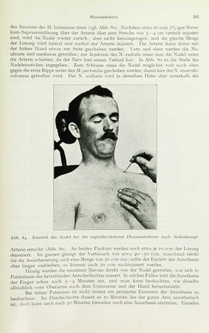 des Ansatzes des M. latissimus dorsi (vgl. Abb. 8o). Nachdem etwa lo ccm 2°oigerNovo- kain-Suprareninlösung über der Arterie über eine Strecke von 3—4 cm verteilt injiziert sind, wird die Nadel wieder zurück-, aber nicht herausgezogen, und die gleiche Menge der Lösung wird lateral und medial der Arterie injiziert. Die .Arterie kann dabei mit der linken Hand etwas zur Seite geschoben werden. \'orn und oben werden die Nn. ulnaris und medianus getroffen; zur Injektion des N. radialis muss man die Nadel unter die Arterie schieben, da der Nerv hier seinen Verlauf hat. In Abb. 80 ist die Stelle des Nadeleinstiches angegeben. Zum Schlüsse muss die Nadel möglichst weit nach oben gegen die erste Rippe unter den M. pectoralis geschoben werden, damit hier der N. musculo- cutaneus getroffen wird. Der N. axillaris wird in derselben Höhe aber unterhalb der Abb. 84. Einstich der Xadcl bei der ,suprakla\ikularen Plexusanästhesie nach Kulenkampf. Arterie erreicht (Abb. 80). An beiden Punkten werden noch etwa je 10 ccm der Lösung deponiert. Im ganzen genügt der \'erbrauch von etwa 40—50 ccm, manchmal reicht für die Anästhesierung auch eine Menge von 30 ccm aus; sollte der Eintritt der Anästhesie aber län^-er ausbleiben, so können auch 20 ccm nachinjiziert werden. Häufig werden die einzelnen Nerven direkt von der Nadel getroffen, was sich in Parästhesie des betreffenden .-Xmiabschnittes äussert. In solchen Fällen tritt die Anästhesie der Finger schon nach 3—4 Minuten ein, und man kann beobachten, wie dieselbe allmählich vom Oberarme nach dem Unterarme und der Hand herunterzieht. Bei fetten Patienten ist nicht immer ein promptes Eintreten der .Anästhesie zu beobachten. Im Durchschnitte dauert es 10 Minuten, bis der ganze Arm anästhetisch ist doch kann auch nach 30 Minuten bisweilen noch eine Anästhesie eintreten. Einzehie