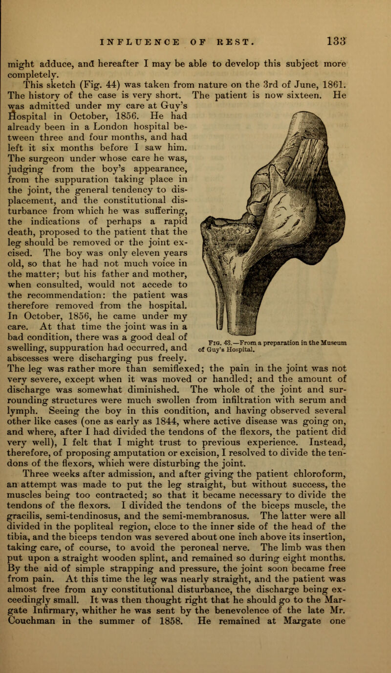 might adduce, and hereafter I may be able to develop this subject more completely. This sketch (Fig. 44) was taken from nature on the 3rd of June, 1861. The history of the case is very short. The patient is now sixteen. He was admitted under my care at Guy's fiospital in October, 1856. He had already been in a London hospital be- tween three and four months, and had left it six months before I saw him. The surgeon under whose care he was, judging from the boy's appearance, from the suppuration taking place in the joint, the general tendency to dis- placement, and the constitutional dis- turbance from which he was suffering, the indications of perhaps a rapid death, proposed to the patient that the leg should be removed or the joint ex- cised. The boy was only eleven years old, so that he had not much voice in the matter; but his father and mother, when consulted, would not accede to the recommendation: the patient was therefore removed from the hospital. In October, 1856, he came under my care. At that time the joint was in a bad condition, there was a good deal of swelling, suppuration had occurred, and abscesses were discharging pus freely. The leg was rather more than semiflexed; the pain in the joint was not very severe, except when it was moved or handled; and the amount of discharge was somewhat diminished. The whole of the joint and sur- rounding structures were much swollen from infiltration with serum and lymph. Seeing the boy in this condition, and having observed several other like cases (one as early as 1844, where active disease was going on, and where, after I had divided the tendons of the flexors, the patient did very well), I felt that I might trust to previous experience. Instead, therefore, of proposing amputation or excision, I resolved to divide the ten- dons of the flexors, which were disturbing the joint. Three weeks after admission, and after giving the patient chloroform, an attempt was made to put the leg straight, but without success, the muscles being too contracted; so that it became necessary to divide the tendons of the flexors. I divided the tendons of the biceps muscle, the gracilis, semi-tendinosus, and the semi-membranosus. The latter were all divided in the popliteal region, cloce to the inner side of the head of the tibia, and the biceps tendon was severed about one inch above its insertion, taking care, of course, to avoid the peroneal nerve. The limb was then put upon a straight wooden splint, and remained so during eight months. By the aid of simple strapping and pressure, the joint soon became free from pain. At this time the leg was nearly straight, and the patient was almost free from any constitutional disturbance, the discharge being ex- ceedingly small. It was then thought right that he should go to the Mar- gate Infirmary, whither he was sent by the benevolence of the late Mr. Couchman in the summer of 1858. He remained at Margate one Fig. 43.—From a preparation in the Museum of Guy* 8 Hospital.