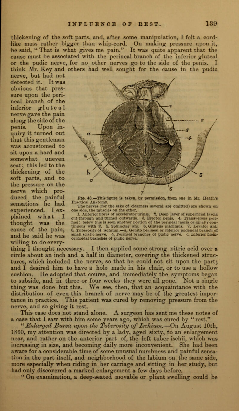 thickening of the soft parts, and, after some manipulation, I felt a cord- like mass rather bigger than whip-cord. On making pressure upon it. he said,  That is what gives me pain. It was quite apparent that the cause must be associated with the perineal branch of the inferior gluteal or the pudic nerve, for no other nerves go to the side of the penis. I think Mr. Key and others had well sought for the cause in the pudic nerve, but had not detected it. It was obvious that pres- sure upon the peri- neal branch of the inferior gluteal nerve gave the pain along1 the side of the penis. Lpon in- quiry it turned out that this gentleman was accustomed to sit upon a hard and somewhat uneven seat; this led to the thickening of the soft parts, and to the pressure on the nerve which pro- duced the painful sensations he had experienced. I ex- plained what I thought was the cause of the pain, and he said he was willing to do every- thing I thought necessary. I then applied some strong nitric acid over a circle about an inch and a half in diameter, covering the thickened struc- tures, which included the nerve, so that he could not sit upon the part; and I desired him to have a hole made in his chair, or to use a hollow cushion. He adopted that course, and immediately the symptoms began to subside, and in three or four weeks they were all gone. Xot a single thing was done but this. We see, then, that an acquaintance with the distribution of even this branch of nerve may be of the greatest impor- tance in practice. This patient was cured by removing pressure from the nerve, and so giving it rest. This case does not stand alone. A surgeon has sent me these notes of a case that I saw with him some years ago, which was cured by  rest.  Enlarged Bursa upon the Tuberosity of Ischium.—On August 10th, 1860, my attention was directed by a lady, aged sixty, to an enlargement near, and rather on the anterior part of, the left tuber ischii, which was increasing in size, and becoming daily more inconvenient. She had been aware for a considerable time of some unusual numbness and painful sensa- tion in the part itself, and neighborhood of the labium on the same side, more especially when riding in her carriage and sitting in her study, but had only discovered a marked enlargement a few days before. 11 On examination, a deep-seated movable or pliant swelling could be Fig. 4S.—This figure is taken, by permission, from one in Mr. H Practical Anatomy. The nerves (for the .sake of clearness several are omitted) are shown on one ride, the muscles on the other. 1. Anterior fibres of accelerator urinae. 2. Deep layer of superficial fascia cut through and turned outwards. 3, Erector penis. 4. Transversa* peri- na?i: below this is seen another portion of the perineal fascia orieinally con- tinuous with 2. 5. Sphincter ani. 6. Gluteus maximus. 7, Levator ani. 8, Tuberosity of ischium.—a, Genito perineal or inferior psdendal branch of small static nerve. 6, Perineal branches of pudic nerve, c, Inferior hem- orrhoidal branches of pudic nerve.