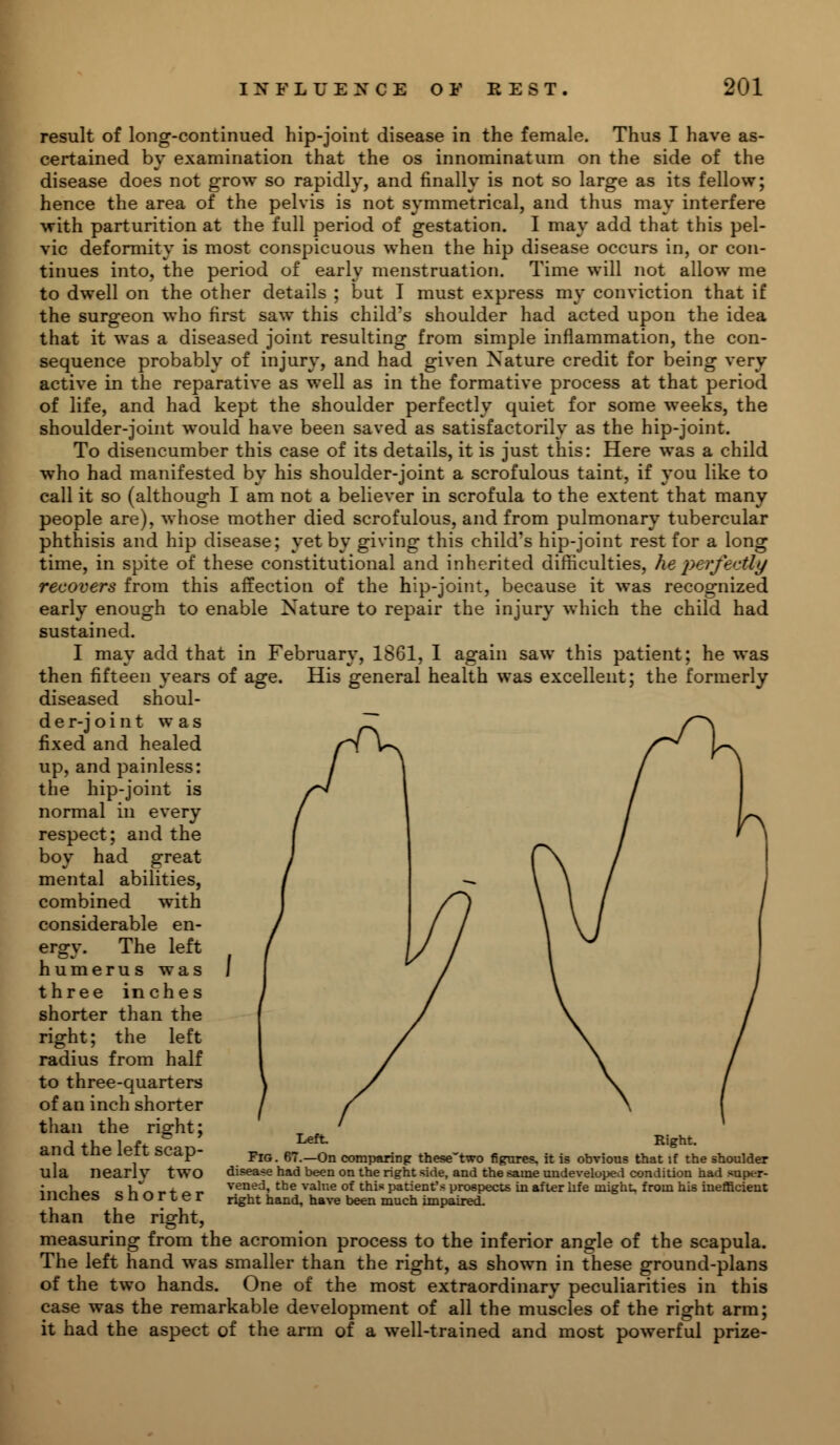result of long-continued hip-joint disease in the female. Thus I have as- certained by examination that the os innominatum on the side of the disease does not grow so rapidly, and finally is not so large as its fellow; hence the area of the pelvis is not symmetrical, and thus may interfere with parturition at the full period of gestation. I may add that this pel- vic deformity is most conspicuous when the hip disease occurs in, or con- tinues into, the period of early menstruation. Time will not allow me to dwell on the other details ; but I must express my conviction that if the surgeon who first saw this child's shoulder had acted upon the idea that it was a diseased joint resulting from simple inflammation, the con- sequence probably of injury, and had given Nature credit for being very active in the reparative as well as in the formative process at that period of life, and had kept the shoulder perfectly quiet for some weeks, the shoulder-joint would have been saved as satisfactorily as the hip-joint. To disencumber this case of its details, it is just this: Here was a child who had manifested by his shoulder-joint a scrofulous taint, if you like to call it so (although I am not a believer in scrofula to the extent that many people are), whose mother died scrofulous, and from pulmonary tubercular phthisis and hip disease; yet by giving this child's hip-joint rest for a long time, in spite of these constitutional and inherited difficulties, he perfectly recovers from this affection of the hip-joint, because it was recognized early enough to enable Nature to repair the injury which the child had sustained. I may add that in February, 1861, I again saw this patient; he was then fifteen years of age. His general health was excellent; the formerly diseased shoul- der-joint was fixed and healed up, and painless: the hip-joint is normal in every respect; and the boy had great mental abilities, combined with considerable en- ergy. The left humerus was three inches shorter than the right; the left radius from half to three-quarters of an inch shorter than the right; and the left scap- ula nearly two inches shorter than the right, measuring from the acromion process to the inferior angle of the scapula. The left hand was smaller than the right, as shown in these ground-plans of the two hands. One of the most extraordinary peculiarities in this case was the remarkable development of all the muscles of the right arm; it had the aspect of the arm of a well-trained and most powerful prize- Left. Right. Fig. 67.—On comparing thesetwo figures, it is obvious that if the shoulder disease had been on the right side, and the same undeveloped condition had super- vened, the value of this patient's prospects in after life might, from his inefficient right hand, have been much impaired.