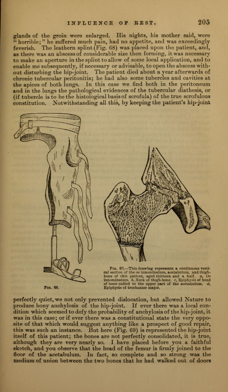 glands of the groin were enlarged. His nights, his mother said, were  horrible; he suffered much pain, had no appetite, and was exceedingly- feverish. The leathern splint (Fig. 68) was placed upon the patient, and, as there was an abscess of considerable size then forming, it was necessary to make an aperture in the splint to allow of some local application, and to enable me subsequently, if necessary or advisable, to open the abscess with- out disturbing the hip-joint. The patient died about a year afterwards of chronic tubercular peritonitis; he had also some tubercles and cavities at the apices of both lungs. In this case we find both in the peritoneum and in the lungs the pathological evidences of the tubercular diathesis, or (if tubercle is to be the histological basis of scrofula) of the true scrofulous constitution. Notwithstanding all this, by keeping the patient's hip-joint Fig. 68. Fig. 60.—This drawing represents a continuous verti- cal section of the os innominatum. acetabulum, and thigh- bone of this patient, aged thirteen and a half, a, Os innominatum. ft. Neck of thigh-bone, c, Epiphysis of head of bone united to the upper part of the acetabulum, d, Epiphysis of trochanter major. perfectly quiet, we not only prevented dislocation, but allowed Nature to produce bony anchylosis of the hip-joint. If ever there was a local con- dition which seemed to defy the probability of anchylosis of the hip-joint, it was in this case; or if ever there was a constitutional state the very oppo- site of that which would suggest anything like a prospect of good repair, this was such an instance. But here (Fig. 69) is represented the hip-joint itself of this patient; the bones are not perfectly consolidated, it is true, although they are very nearly so. I have placed before you a faithful sketch, and you observe that the head of the femur is firmly joined to the floor of the acetabulum. In fact, so complete and so strong was the medium of union between the two bones that he had walked out of doors