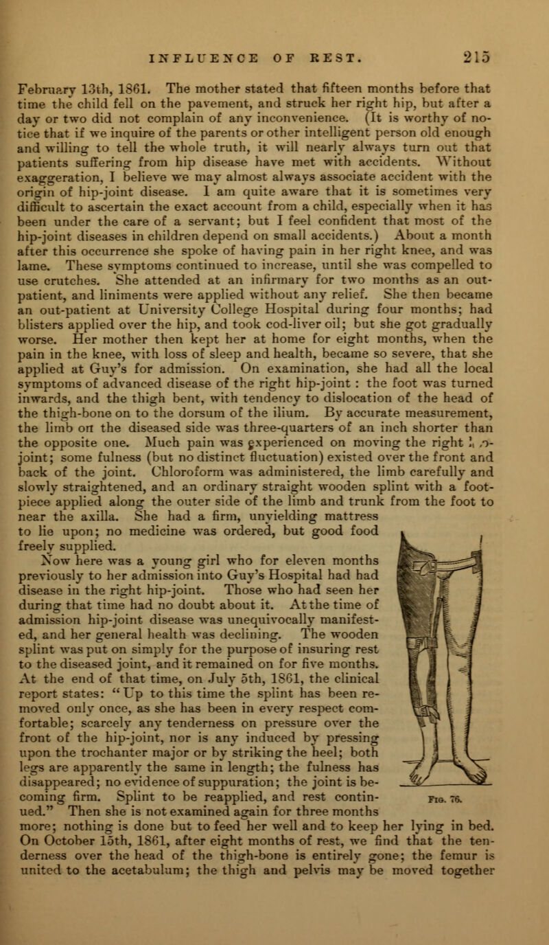 February 13th, 1S61. The mother stated that fifteen months before that time the child fell on the pavement, and struck her right hip, but after a day or two did not complain of any inconvenience. (It is worthy of no- tice that if we inquire of the parents or other intelligent person old enough and willing to tell the whole truth, it will nearly always turn out that patients suffering from hip disease have met with accidents. Without exaggeration, I believe we may almost always associate accident with the origin of hip-joint disease. 1 am quite aware that it is sometimes very difficult to ascertain the exact account from a child, especially when it has been under the care of a servant; but I feel confident that most of the hip-joint diseases in children depend on small accidents.) About a month after this occurrence she spoke of having pain in her right knee, and was lame. These symptoms continued to increase, until she was compelled to use crutches. She attended at an infirmary for two months as an out- patient, and liniments were applied without any relief. She then became an out-patient at University College Hospital during four months; had blisters applied over the hip, and took cod-liver oil; but she got gradually worse. Her mother then kept her at home for eight months, when the pain in the knee, with loss of sleep and health, became so severe, that she applied at Guy's for admission. On examination, she had all the local symptoms of advanced disease of the right hip-joint : the foot was turned inwards, and the thigh bent, with tendency to dislocation of the head of the thigh-bone on to the dorsum of the ilium. By accurate measurement, the limb on the diseased side was three-quarters of an inch shorter than the opposite one. Much pain was experienced on moving the right !, ,o- joint; some fulness (but no distinct fluctuation) existed over the front and back of the joint. Chloroform was administered, the limb carefully and slowly straightened, and an ordinary straight wooden splint with a foot- piece applied along the outer side of the limb and trunk from the foot to near the axilla. She had a firm, unyielding mattress to lie upon; no medicine was ordered, but good food freely supplied. Now here was a young girl who for eleven months previously to her admission into Guy's Hospital had had disease in the right hip-joint. Those who had seen her during that time had no doubt about it. At the time of admission hip-joint disease was unequivocally manifest- ed, and her general health was declining. The wooden splint was put on simply for the purpose of insuring rest to the diseased joint, and it remained on for five months. At the end of that time, on July 5th, 1861, the clinical report states: Up to this time the splint has been re- moved only once, as she has been in every respect com- fortable; scarcely any tenderness on pressure over the front of the hip-joint, nor is any induced by pressing upon the trochanter major or by striking the heel; both legs are apparently the same in length; the fulness has disappeared; no evidence of suppuration; the joint is be- coming firm. Splint to be reapplied, and rest contin- ued. Then she is not examined again for three months more; nothing is done but to feed her well and to keep her lying in bed. On October 15th, 1861, after eight months of rest, we find that the ten- derness over the head of the thigh-bone is entirely gone; the femur is united to the acetabulum; the thigh and pelvis may be moved together Fig. 76.