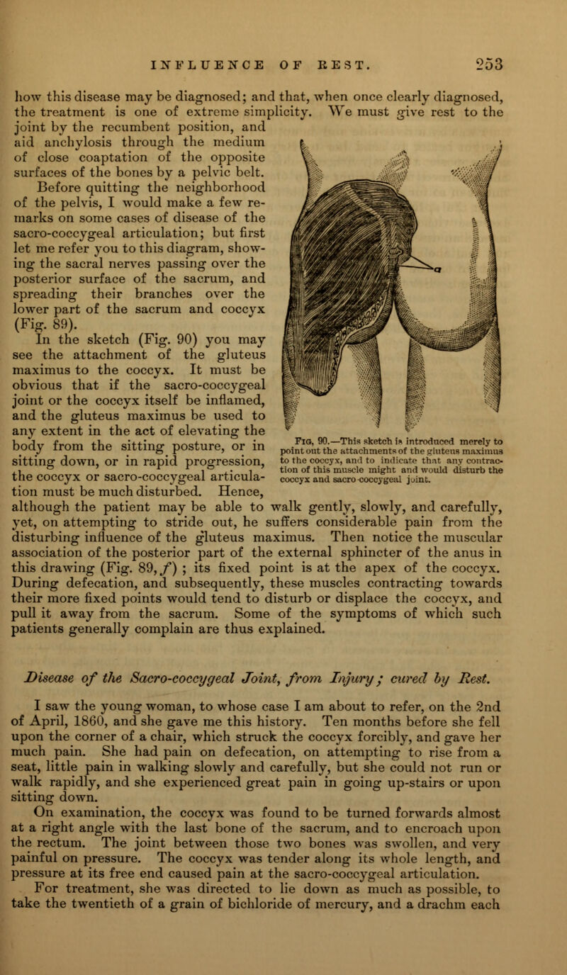 how this disease may be diagnosed; and that, when once clearly diagnosed, the treatment is one of extreme simplicity. We must give rest to the joint by the recumbent position, and aid anchylosis through the medium of close coaptation of the opposite surfaces of the bones by a pelvic belt. Before quitting the neighborhood of the pelvis, I would make a few re- marks on some cases of disease of the sacro-coccygeal articulation; but first let me refer you to this diagram, show- ing the sacral nerves passing over the posterior surface of the sacrum, and spreading their branches over the lower part of the sacrum and coccyx (Fig. 89). In the sketch (Fig. 90) you may see the attachment of the gluteus maximus to the coccyx. It must be obvious that if the sacro-coccygeal joint or the coccyx itself be inflamed, and the gluteus maximus be used to any extent in the act of elevating the body from the sitting posture, or in sitting down, or in rapid progression, the coccyx or sacro-coccygeal articula- tion must be much disturbed. Hence, although the patient may be able to walk gently, slowly, and carefully, yet, on attempting to stride out, he suffers considerable pain from the disturbing influence of the gluteus maximus. Then notice the muscular association of the posterior part of the external sphincter of the anus in this drawing (Fig. 89, f) ; its fixed point is at the apex of the coccyx. During defecation, and subsequently, these muscles contracting towards their more fixed points would tend to disturb or displace the coccyx, and pull it away from the sacrum. Some of the symptoms of which such patients generally complain are thus explained. Fig, 90.—This sketch i« introduced merely to point out the attachments of the gluteus maximus to the coccyx, and to indicate that any contrac- tion of this muscle might and would disturb the coccyx and sacro-coccygeal joint. Disease of the Sacro-coccygeal Joint, from Injury • cured by Best. I saw the young woman, to whose case I am about to refer, on the 2nd of April, 1860, and she gave me this history. Ten months before she fell upon the corner of a chair, which struck the coccyx forcibly, and gave her much pain. She had pain on defecation, on attempting to rise from a seat, little pain in walking slowly and carefully, but she could not run or walk rapidly, and she experienced great pain in going up-stairs or upon sitting down. On examination, the coccyx was found to be turned forwards almost at a right angle with the last bone of the sacrum, and to encroach upon the rectum. The joint between those two bones was swollen, and very painful on pressure. The coccyx was tender along its whole length, and pressure at its free end caused pain at the sacro-coccygeal articulation. For treatment, she was directed to lie down as much as possible, to take the twentieth of a grain of bichloride of mercury, and a drachm each