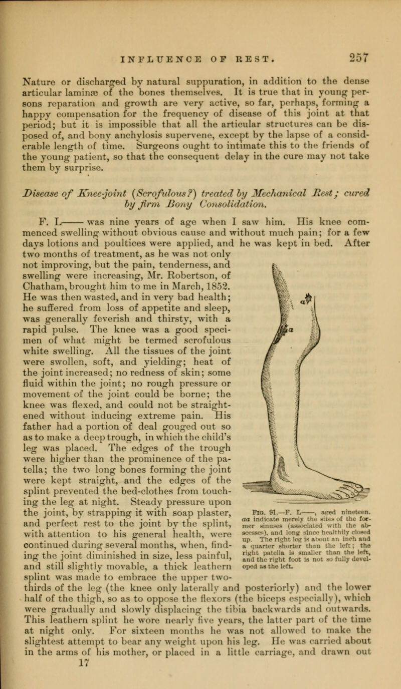 Nature or discharged by natural suppuration, in addition to the d< articular laminSB of the bones themselves. It is true that in young per- sons reparation and growth arc very active, so far, perhaps, forming I happy compensation for the frequency of disease of this joint at that period; but it is impossible that all the articular structures can be dis- posed of, and bony anchylosis supervene, except by the lapse of a consid- erable length of time. Surgeons ought to intimate this to tic friends of the young patient, so that the consequent delay in the cure may not take them by surprise. Disease of Knee-joint {Scrofulous?) treated by Mechanical Best; cured by fi'm Sony Consolidation, F. L was nine years of age when I saw him. His knee com- menced swelling without obvious cause and without much pain; for a few days lotions and poultices were applied, and he was kept in bed. After two months of treatment, as he was not only not improving, but the pain, tenderness, and swelling were increasing, Mr. Robertson, of Chatham, brought him to me in March, 1852. He was then wasted, and in very bad health; he suffered from loss of appetite and sleep, was generally feverish and thirsty, with a rapid pulse. The knee was a good speci- men of what might be termed scrofulous white swelling. All the tissues of the joint were swollen, soft, and yielding; heat of the joint increased; no redness of skin; some fluid within the joint; no rough pressure or movement of the joint could be borne; the knee was flexed, and could not be straight- ened without inducing extreme pain. His father had a portion of deal gouged out so as to make a deep trough, in which the child's leg was placed. The edges of the trough were higher than the prominence of the pa- tella; the two long bones forming the joint were kept straight, and the edges of the splint prevented the bed-clothes from touch- ing the leg at night. Steady pressure upon the joint, by strapping it with soap plaster, and perfect rest to the joint by the splint, with attention to his general health, were continued during several months, when, find- ing the joint diminished in size, less painful, and still slightly movable, a thick leathern splint was made to embrace the upper two- thirds of the leg (the knee only laterally and posteriorly) and the lower half of the thigh, so as to oppose the flexors (the biceps especially), which were gradually and slowly displacing the tibia backwards and outwards. This leathern splint he wore nearly five years, the latter part of the time at night only. For sixteen months lie was not allowed to make the slightest attempt to bear any weight upon his leg. He was carried about in the arms of his mother, or placed in a little carriage, and drawn out 17 Fio. 91.—F. L , aped nineteen. aa indicate merely I the for- mer Bin -• ith the ab- dnoe bealthOj closed up. The ripht leg is atx.ut an inch and a quarter shorter khan tha let: : the right patella is mailer than the left, ami the right font is DOt -*-> fully devel- oped aa the left.