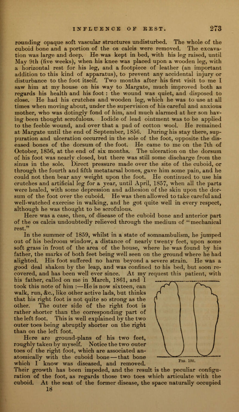 rounding opaque soft vascular structures undisturbed. The whole of the cuboid bone and a portion of the os calcis were removed. The excava- tion was large and deep. He was kept in bed, with his leg raised, until May 9th (five weeks), when his knee was placed upon a wooden leg, with a horizontal rest for his leg, and a footpiece of leather (an important addition to this kind of apparatus), to prevent any accidental injury or disturbance to the foot itself. Two months after his first visit to me I saw him at my house on his way to Margate, much improved both as regards his health and his foot : the wound was quiet, and disposed to close. He had his crutches and wooden leg, which he was to use at all times when moving about, under the supervision of his careful and anxious mother, who was dotingly fond of him, and much alarmed at her son hav- ing been thought scrofulous. Iodide of lead ointment was to be applied to the feeble wound, and over that a pad of cotton wool. He remained at Margate until the end of September, 1856. During his stay there, sup- puration and ulceration occurred in the sole of the foot, opposite the dis- eased bones of the dorsum of the foot. He came to me on the 7th of October, 1856, at the end of six months. The ulceration on the dorsum of his foot was nearly closed, but there was still some discharge from the sinus in the sole. Direct pressure made over the site of the cuboid, or through the fourth and fifth metatarsal bones, gave him some pain, and he could not then bear any weight upon the foot. He continued to use his crutches and artificial leg for a year, until April, 1857, when all the parts were healed, with some depression and adhesion of the skin upon the dor- sum of the foot over the cuboid. He was then allowed to take careful and well-watched exercise in walking, and he got quite well in every respect, although he was thought to be scrofulous. Here was a case, then, of disease of the cuboid bone and anterior part of the os calcis undoubtedly relieved through the medium of mechanical rest. In the summer of 1859, whilst in a state of somnambulism, he jumped out of his bedroom window, a distance of nearly twenty feet, upon some soft grass in front of the area of the house, where he was found by his father, the marks of both feet being well seen on the ground where he had alighted. His foot suffered no harm beyond a severe strain. He was a good deal shaken by the leap, and was confined to his bed, but soon re- covered, and has been well ever since. At my request this patient, with his father, called on me in March, 1861, and I took this note of him :—He is now sixteen, can walk, run, &c, like other active lads, but thinks that his right foot is not quite so strong as the other. The outer side of the right foot is rather shorter than the corresponding part of the left foot. This is well explained by the two outer toes being abruptly shorter on the right than on the left foot. Here are ground-plans of his two feet, roughly taken by myself. Notice the two outer toes of the right foot, which are associated an- atomically with the cuboid bone — that bone which I know was diseased, and removed. Their growth has been impeded, and the result is the peculiar configu- ration of the foot, as regards those two toes which articulate with the cuboid. At the seat of the former disease, the space naturally occupied 18