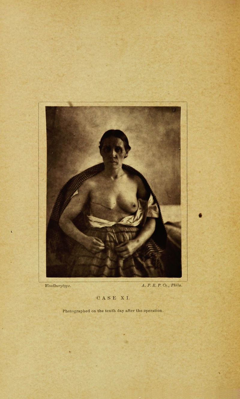 Woodburi/h/fr\ A. P. R. P. Co., Phila. CASE XI. Photographed on the tenth day after the operation.