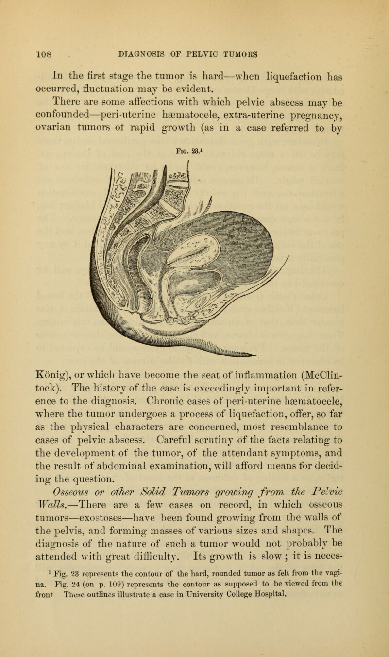 In the first stage the tumor is hard—when liquefaction has occurred, fluctuation may be evident. There are some affections with which pelvic abscess may be confounded—peri-uterine hematocele, extra-uterine pregnancy, ovarian tumors of rapid growth (as in a case referred to by Fig. 28.» Konig), or which have become the seat of inflammation (McClin- tock). The history of the case is exceedingly important in refer- ence to the diagnosis. Chronic cases of peri-uterine hematocele, where the tumor undergoes a process of liquefaction, offer, so far as the physical characters are concerned, most resemblance to cases of pelvic abscess. Careful scrutiny of the facts relating to the development of the tumor, of the attendant symptoms, and the result of abdominal examination, will afford means for decid- ing the question. Osseous or other Solid Tumors growing from the Pelvic Walls.—There are a few cases on record, in which osseous tumors—exostoses—have been found growing from the walls of the pelvis, and forming masses of various sizes and shapes. The diagnosis of the nature of such a tumor would not probably be attended with great difficulty. Its growth is slow ; it is neces- 1 Fig. 23 represents the contour of the hard, rounded tumor as felt from the vagi- na. Fig. 24 (on p. 109) represents the contour as supposed to be viewed from the front Those outlines illustrate a case in University College Hospital.