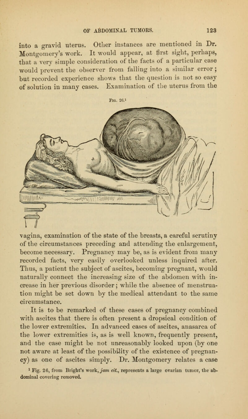 into a gravid uterus. Other instances are mentioned in Dr. Montgomery's work. It would appear, at first sight, perhaps, that a very simple consideration of the facts of a particular case would prevent the observer from falling into a similar error; but recorded experience shows that the question is not so easy of solution in many cases. Examination of the uterus from the Fig. 26.! vagina, examination of the state of the breasts, a careful scrutiny of the circumstances preceding and attending the enlargement, become necessary. Pregnancy may be, as is evident from many recorded facts, very easily overlooked unless inquired after. Thus, a patient the subject of ascites, becoming pregnant, would naturally connect the increasing size of the abdomen with in- crease in her previous disorder; while the absence of menstrua- tion might be set down by the medical attendant to the same circumstance. It is to be remarked of these cases of pregnancy combined with ascites that there is often present a dropsical condition of the lower extremities. In advanced cases of ascites, anasarca of the lower extremities is, as is well known, frequently present, and the case might be not unreasonably looked upon (by one not aware at least of the possibility of the existence of pregnan- cy) as one of ascites simply. Dr. Montgomery relates a case 1 Fig. 26, from Bright's work, jam et&, represents a large ovarian tumor, the ab- dominal covering removed.